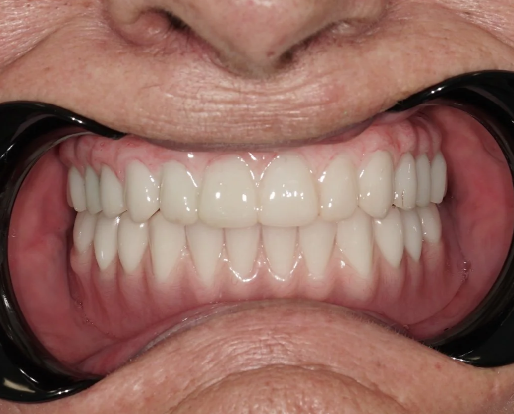 All on X Full Arch Implant Toronto. Close-up picture of full arch implants for upper and lower jaws-2