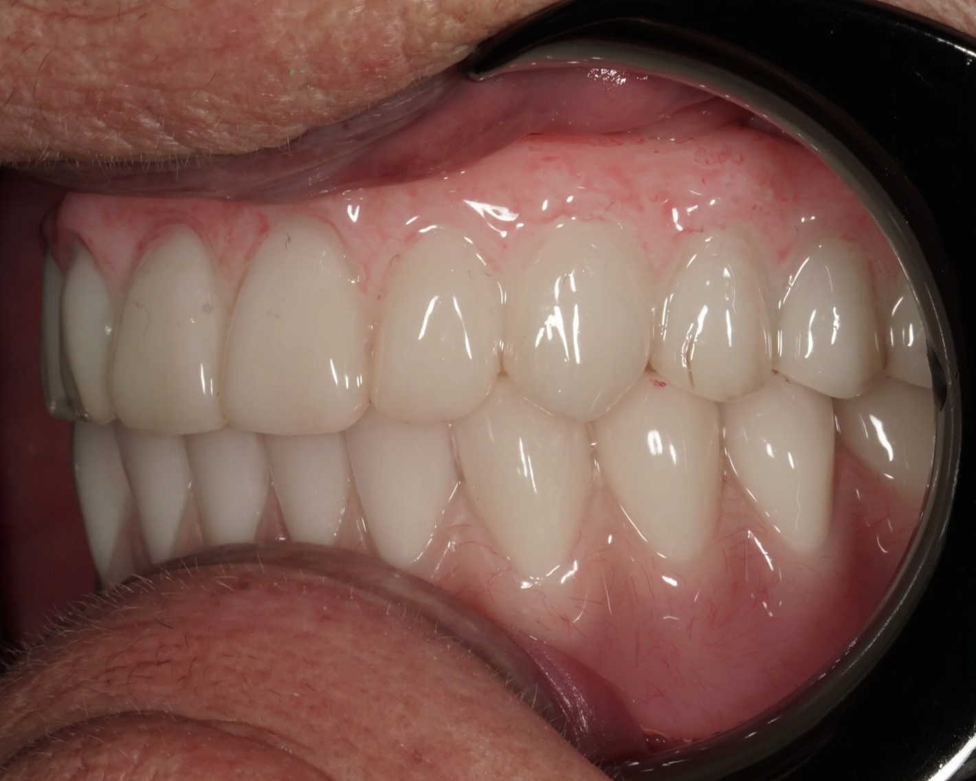 All on X Full Arch Implant Toronto. Close-up picture of full arch implants for upper and lower jaws-Side view