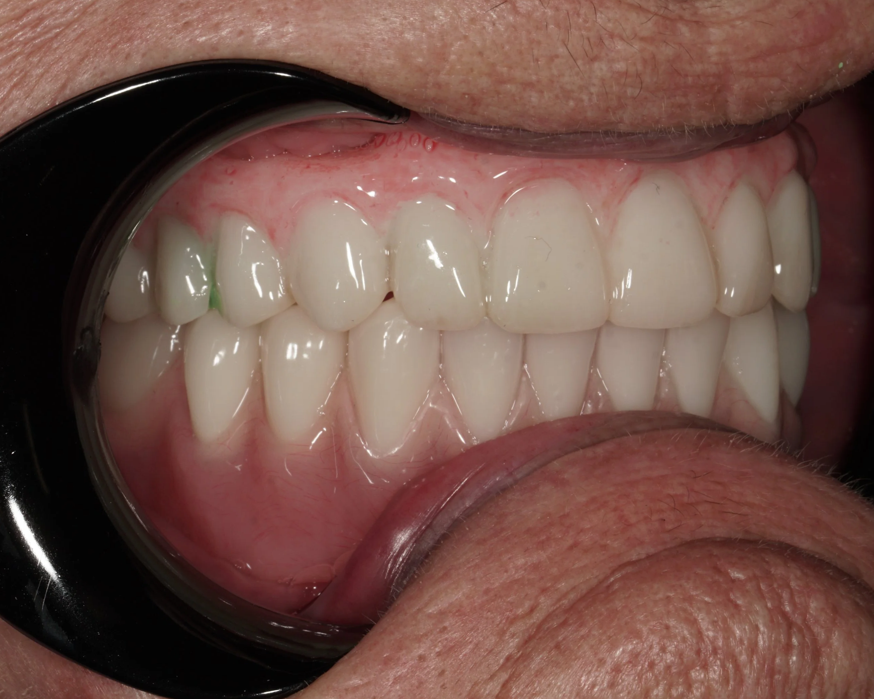 All on X Full Arch Implant Toronto. Close-up picture of full arch implants for upper and lower jaws-Side view