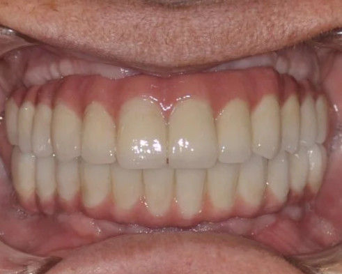 All on 4 Full Arch Implant Toronto. Close-up picture of All on Four implant fixed bridges