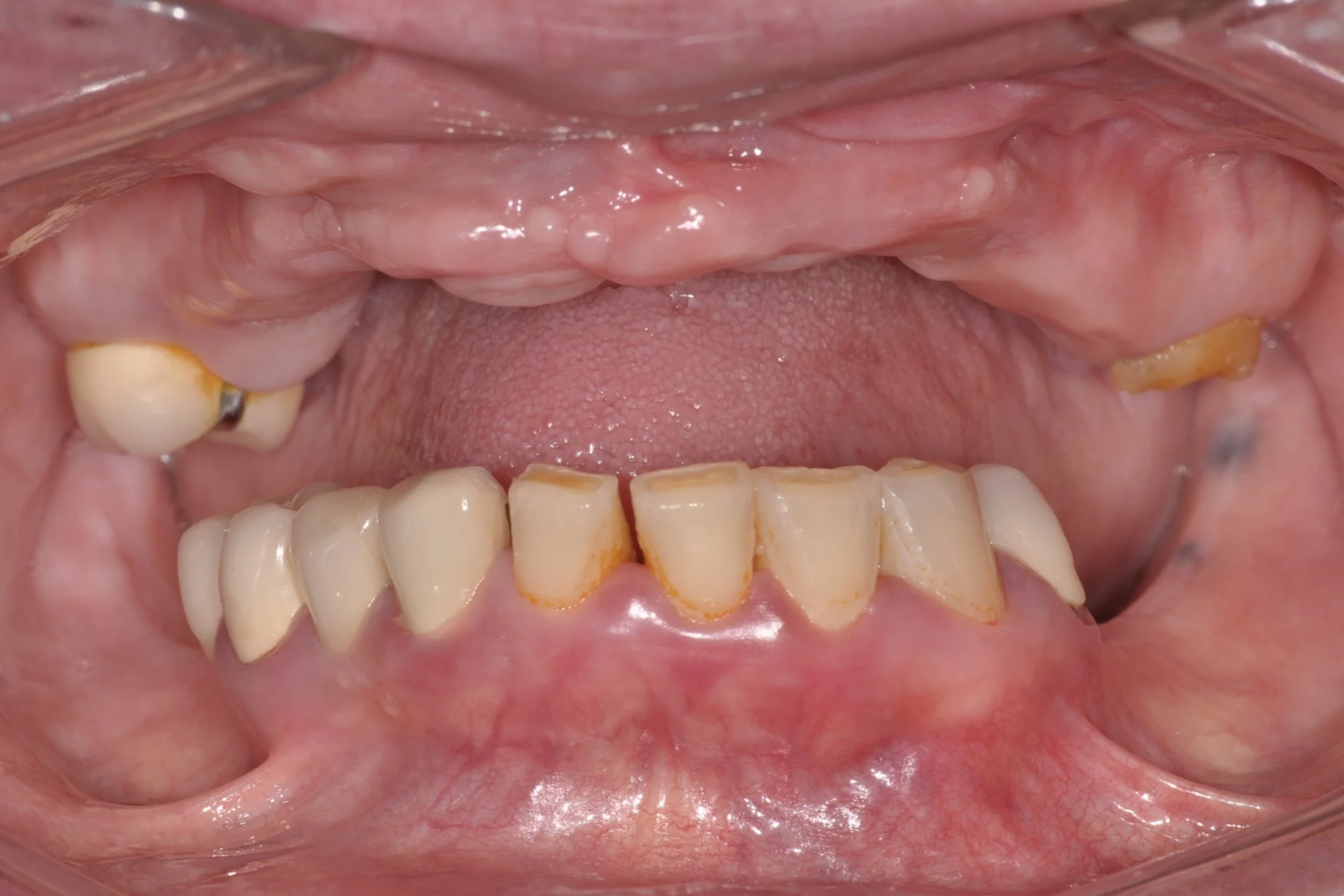 Before upper and lower All on Four implants