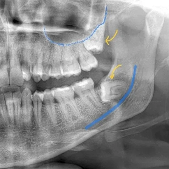 wisdom-teeth-removal-toronto-north-york-dr-onur-cavus.jpg