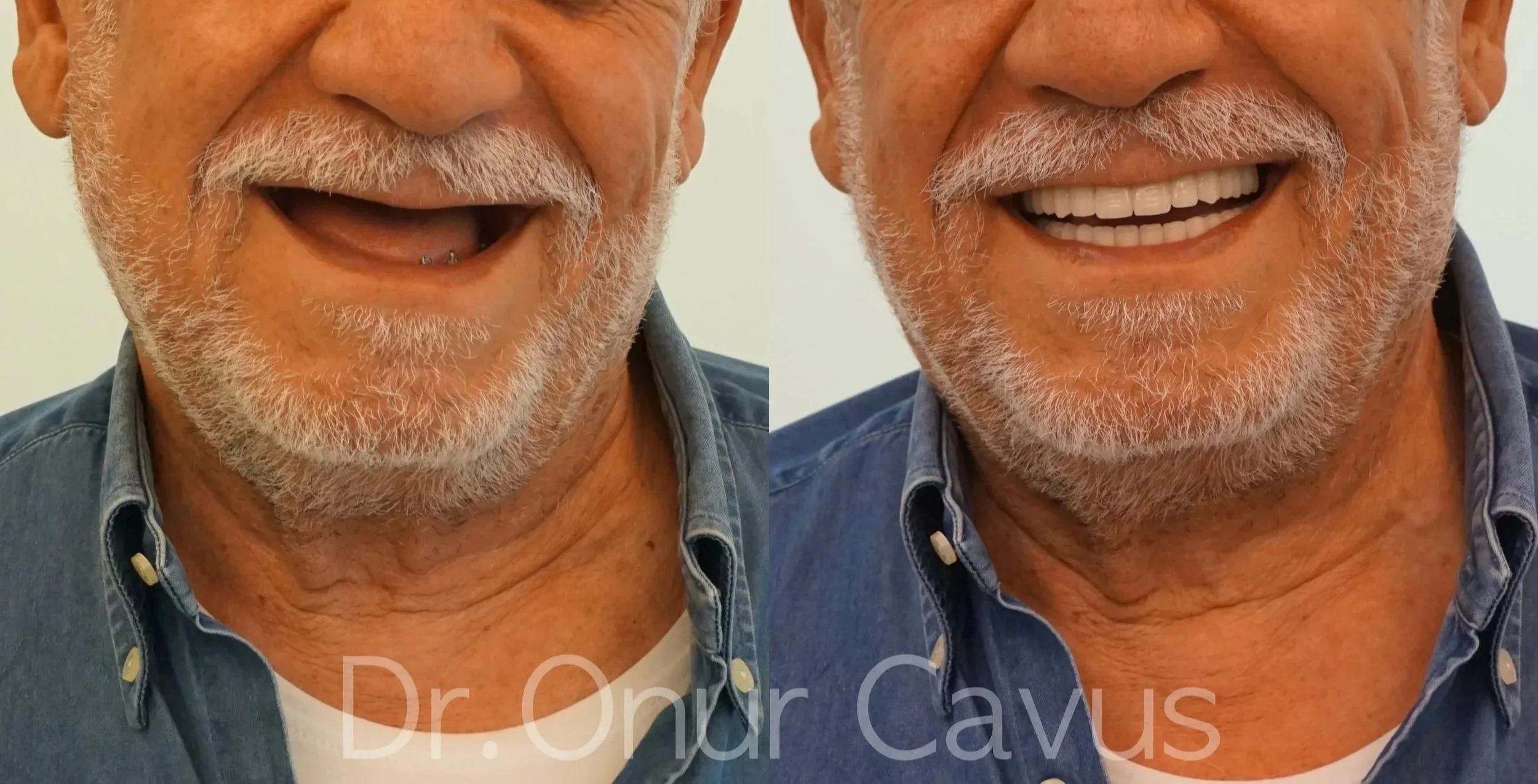 Before and After picture of upper and lower All on 6 Full arch implant case