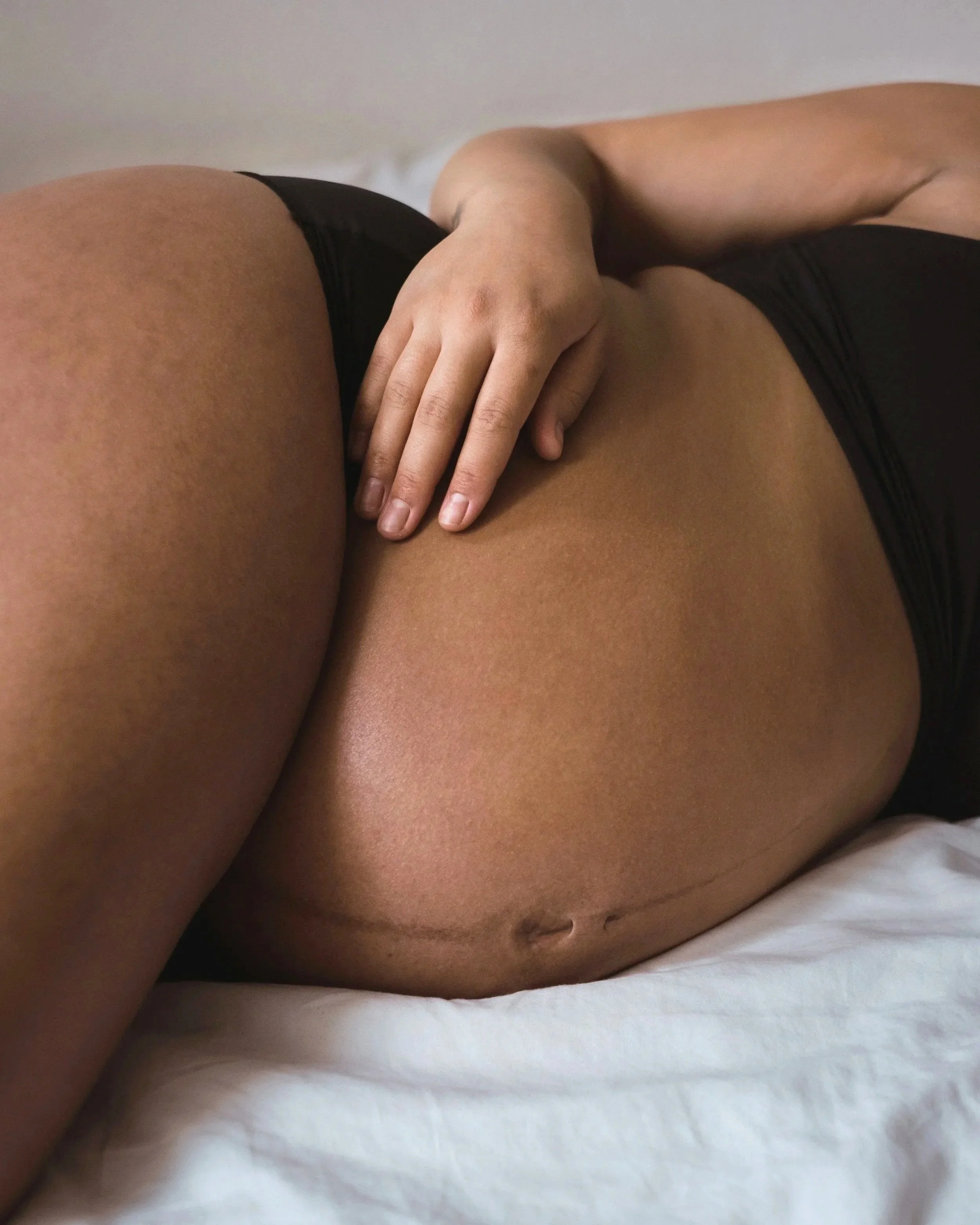 Close-up of a person lying on a bed, showing their side and hand resting on their hip, with a stretch mark visible on their tan skin.