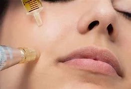 PRP Microneedling Facial