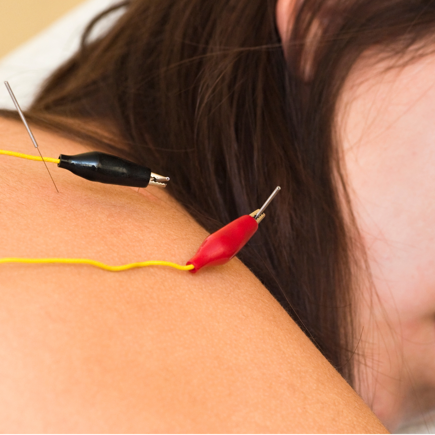 Electric Stimulation.png