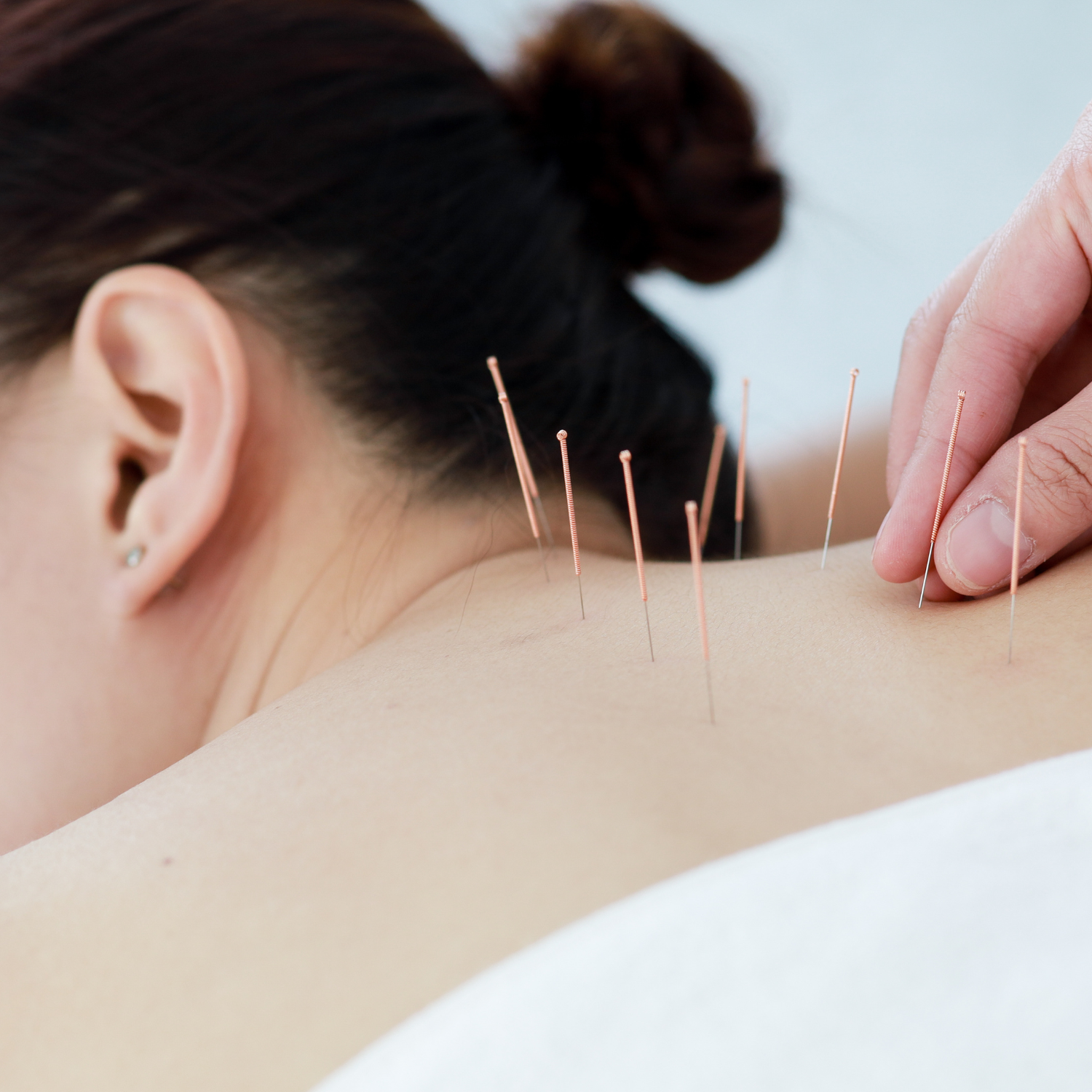 Acupuncture.png