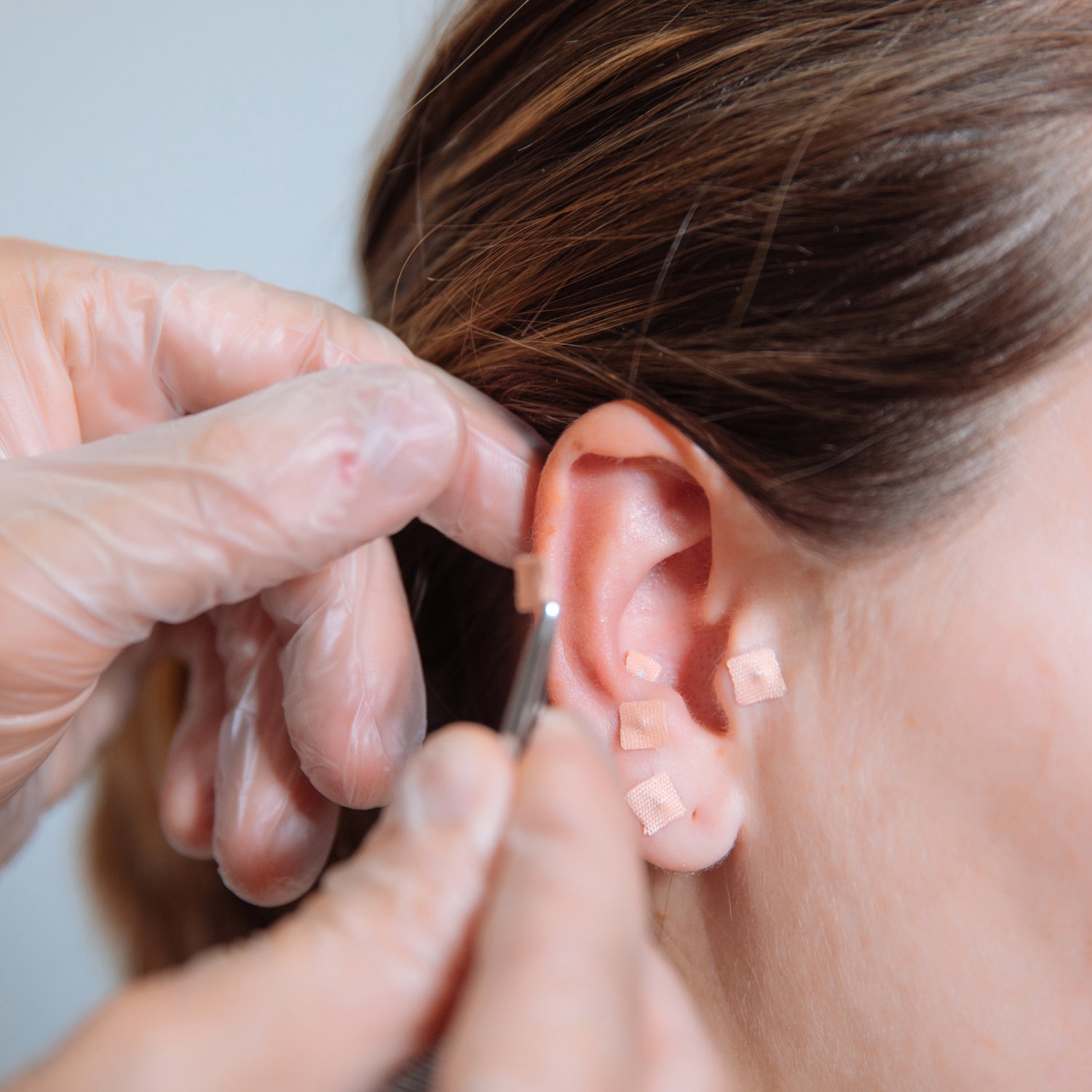 Ear Acupuncture.png