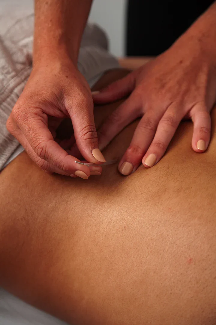 Dry Needling in Physiotherapy: A Powerful Tool for Pain Relief & Recovery