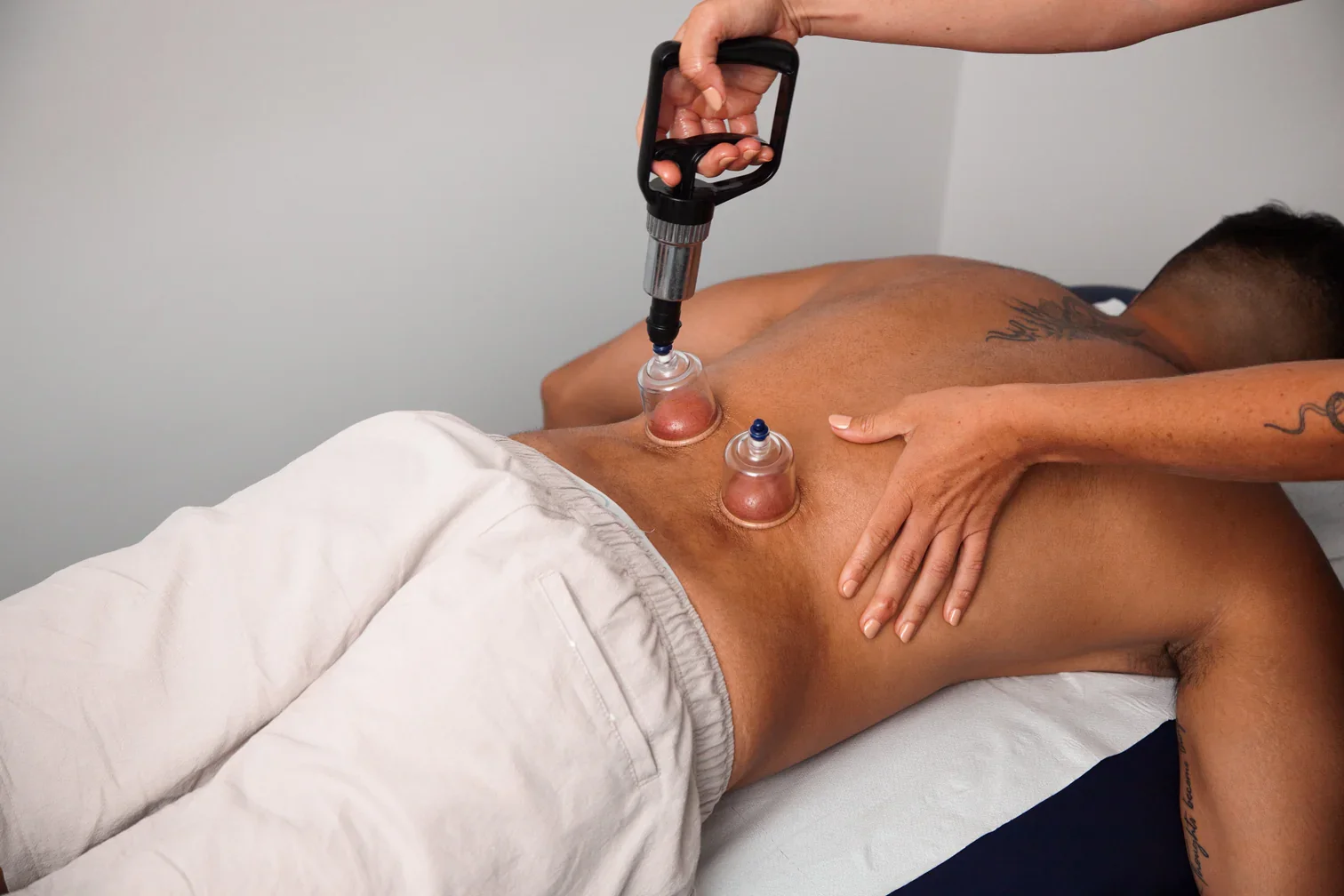 The Benefits of Cupping Therapy in Physiotherapy: How It Can Aid Your Recover