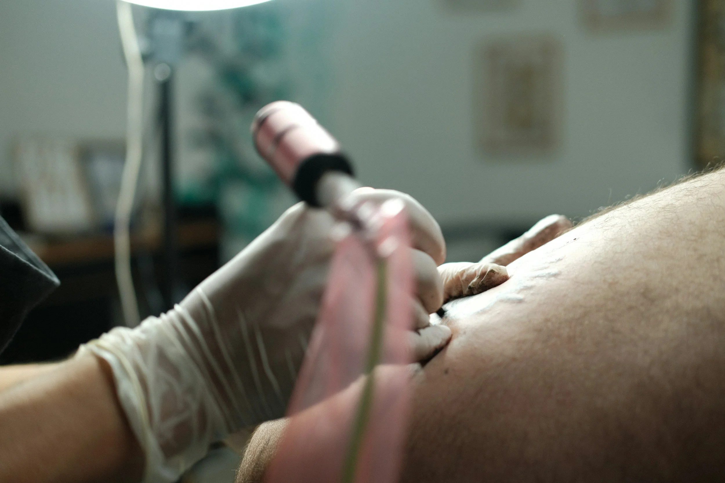 Skin Grafts and Flaps