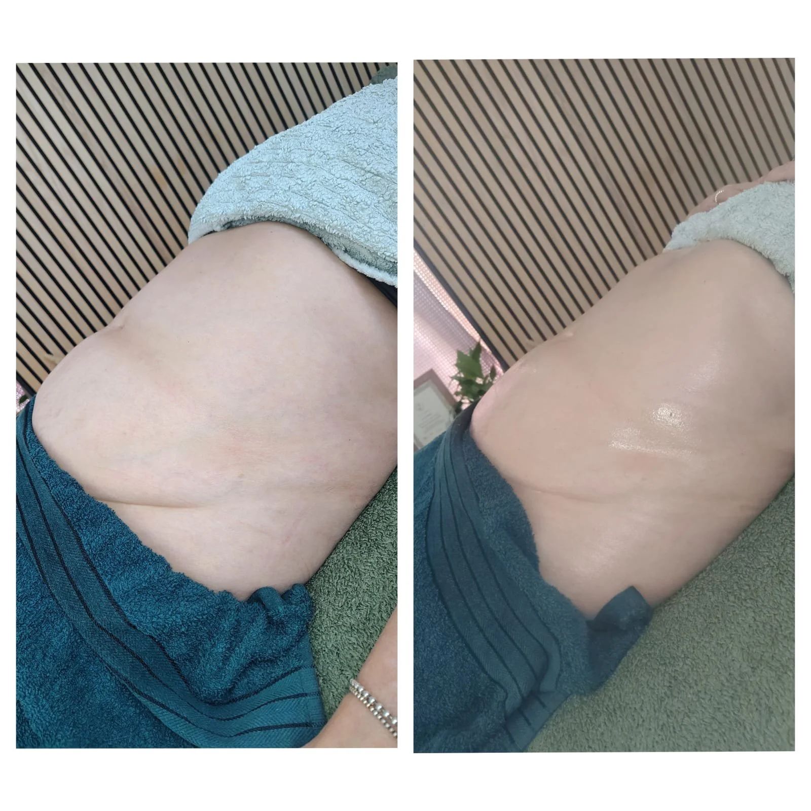 Comparison of a person's lower back before and after a massage or skincare treatment, showing a shiny and smooth appearance in the after photo.