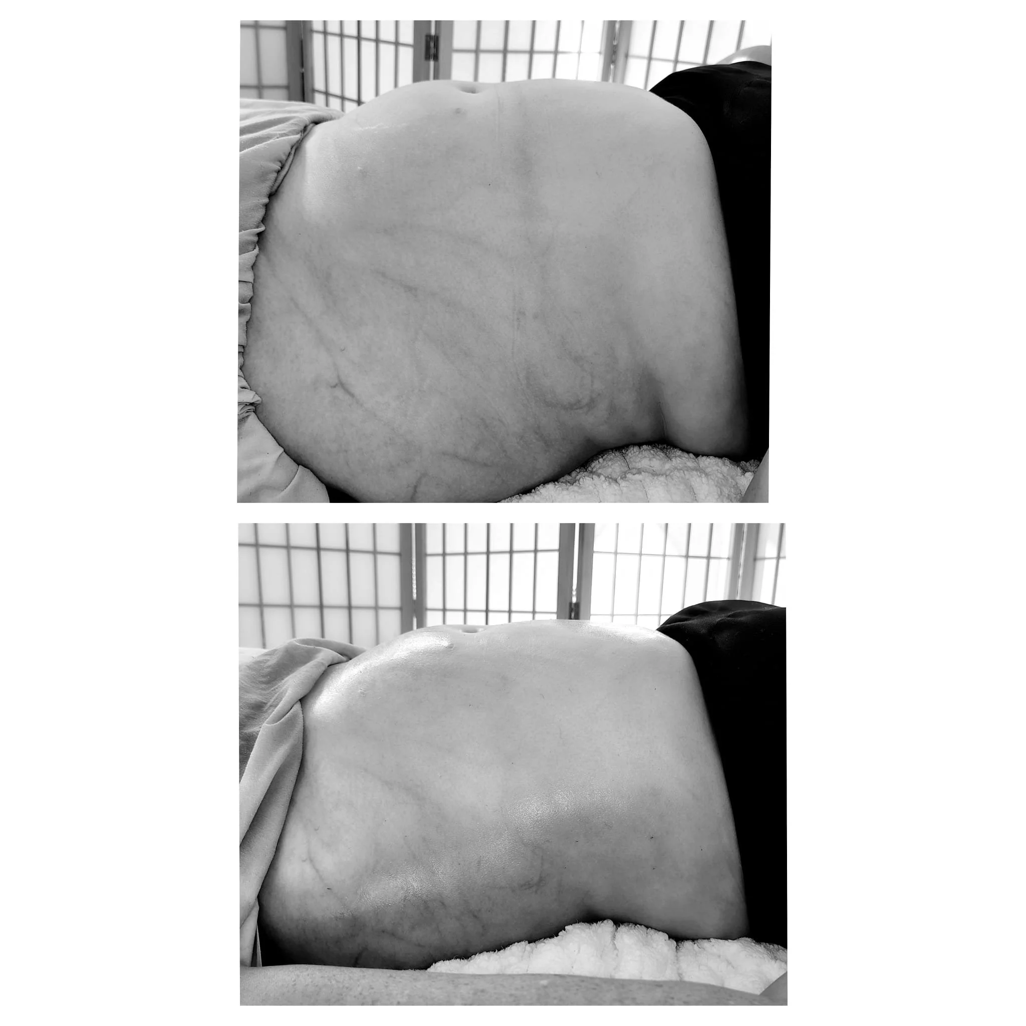 Lymphatic Drainage and Wood Therapy- two areas 90 minutes