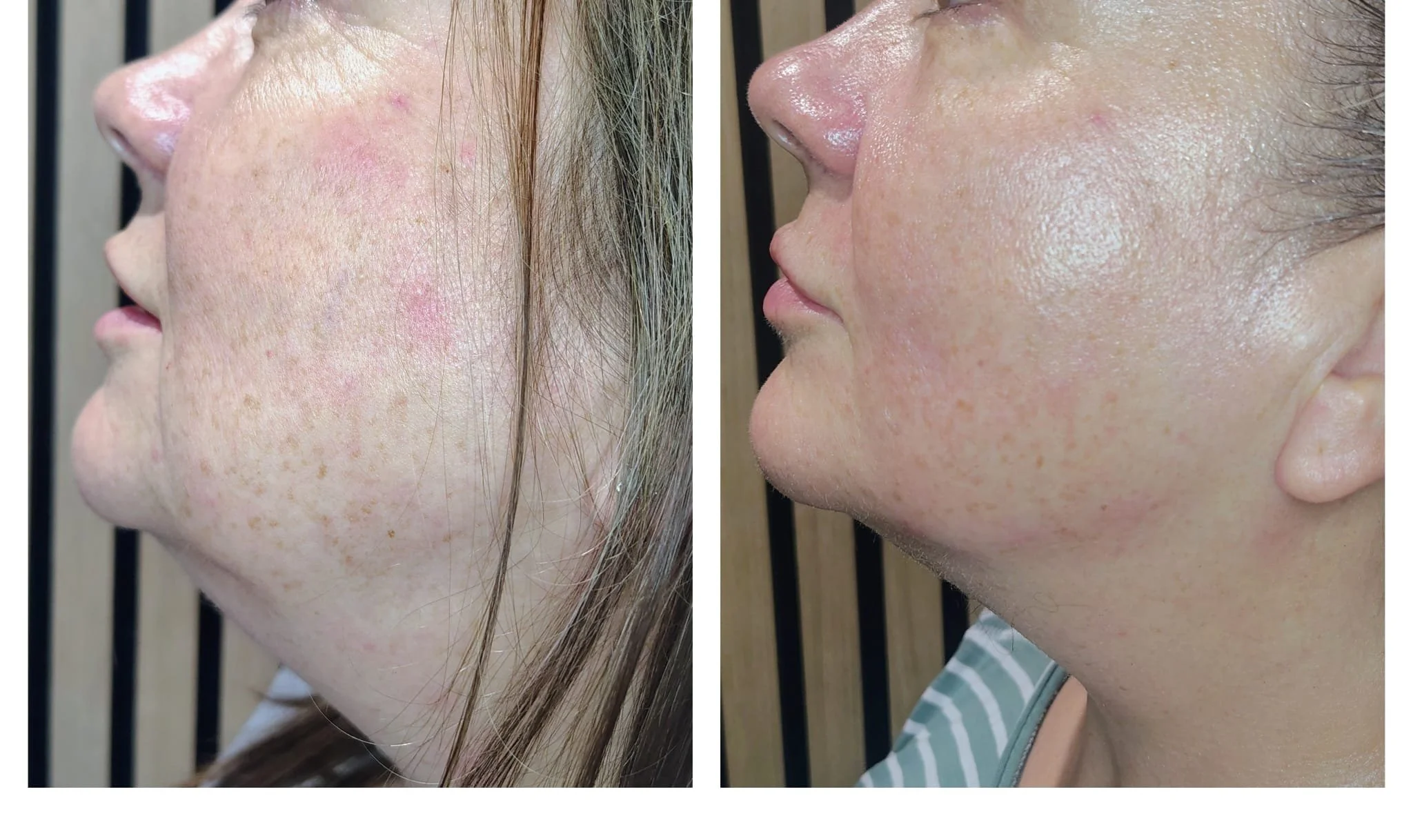 Side-by-side comparison of a person's cheek before and after skincare treatment, showing improvement in skin condition and texture.