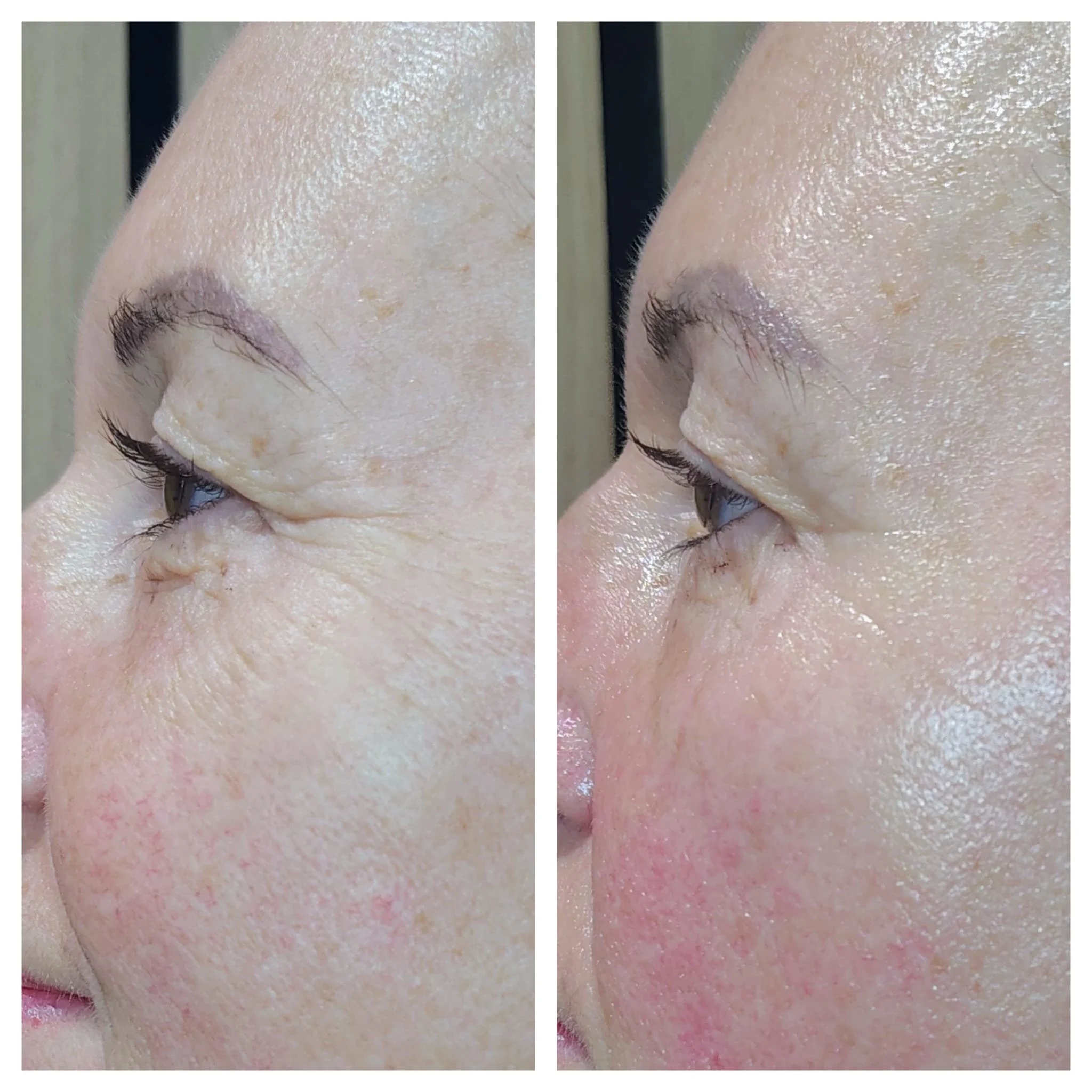 Close-up of a person's forehead and eye area showing skin texture, with a comparison of before and after skincare treatment or makeup application.