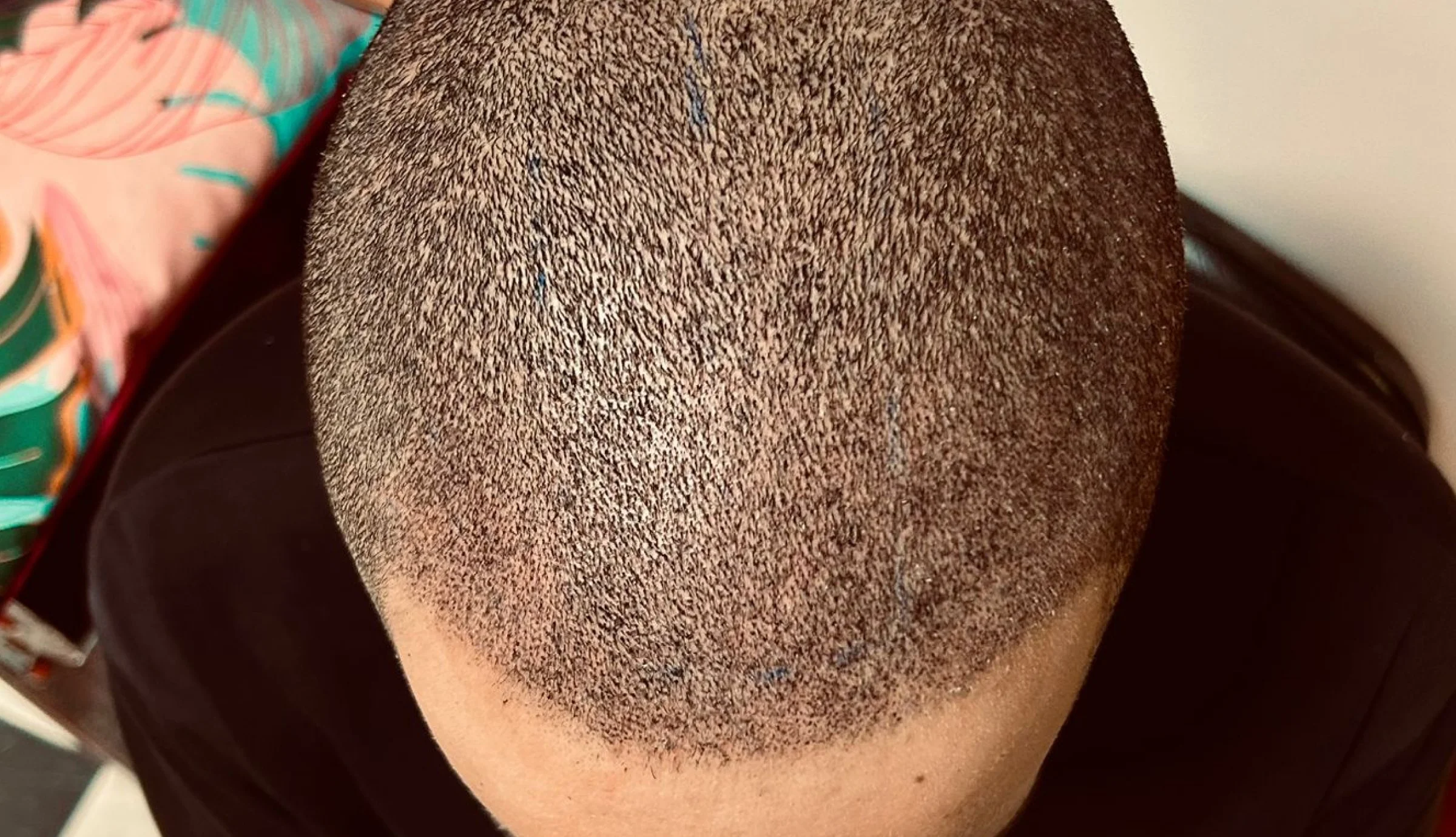 Close-up 'after' shot of a scalp which has undergone the micropigmentation procedure.