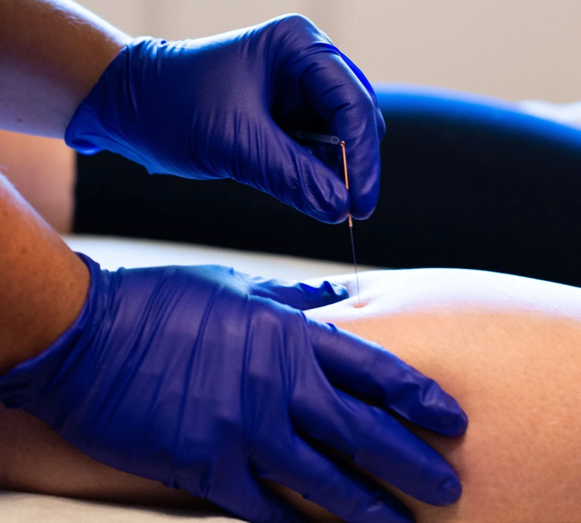A physiotherapist wearing blue gloves inserts a needle into a patient's shoulder for acupuncture treatment.