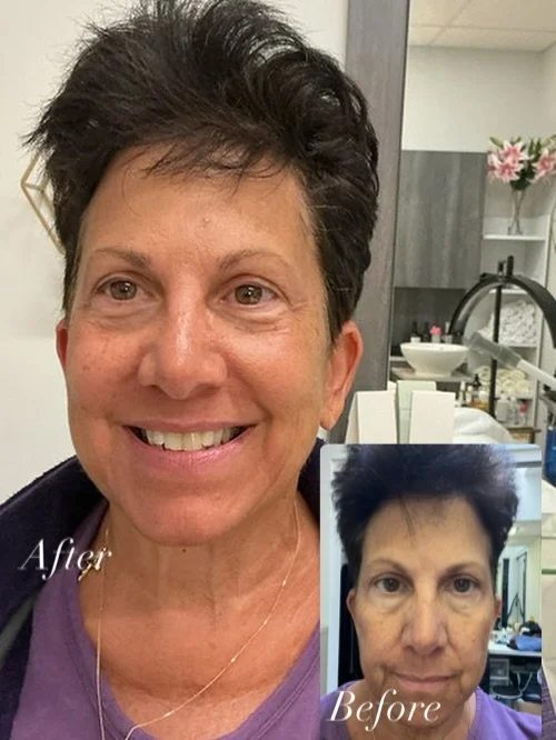 🌿 Brightening Transformation 🌿
Dark spots, dullness, and uneven tone&mdash;&gt; gone! The Bright Skin Dark Spot Facial targets pigmentation for visibly smoother, brighter, and more luminous skin ✨

#MartinaSkinAtelier #WestchesterFacials #HydraFaci