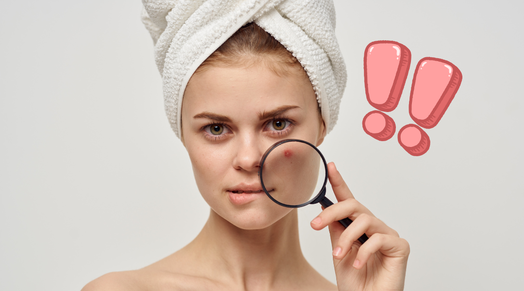 Hydrafacial Treatment for Acne