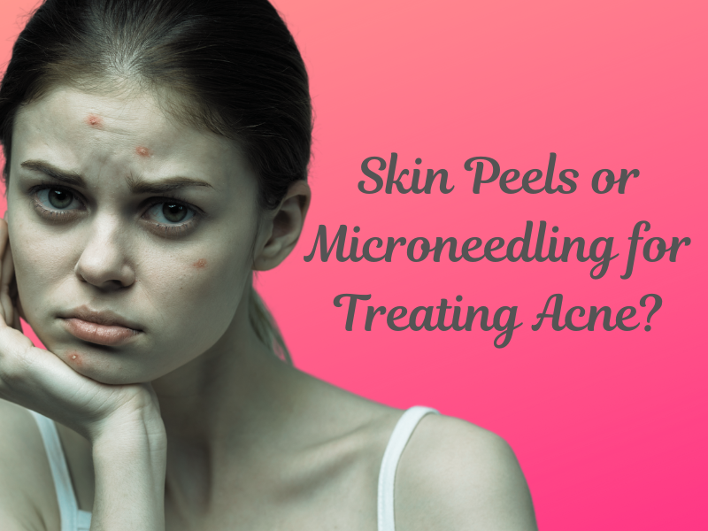 Skin Peels or Microneedling for Treating Acne?