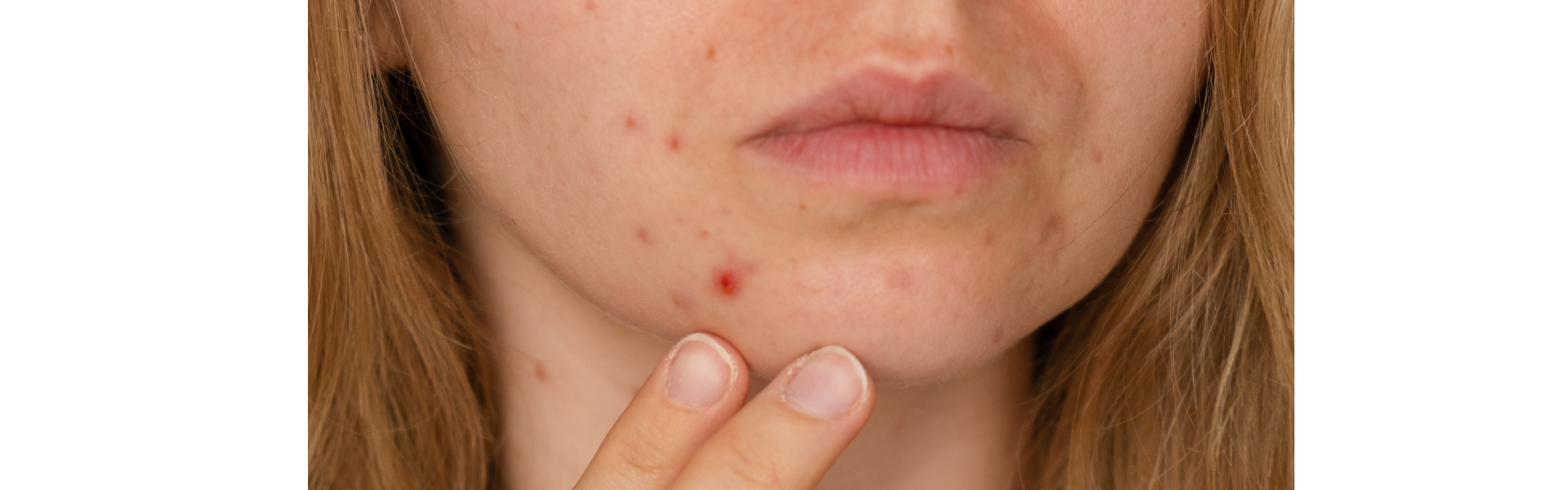 Microneedling – Our #1 Treatment for Acne Scarring