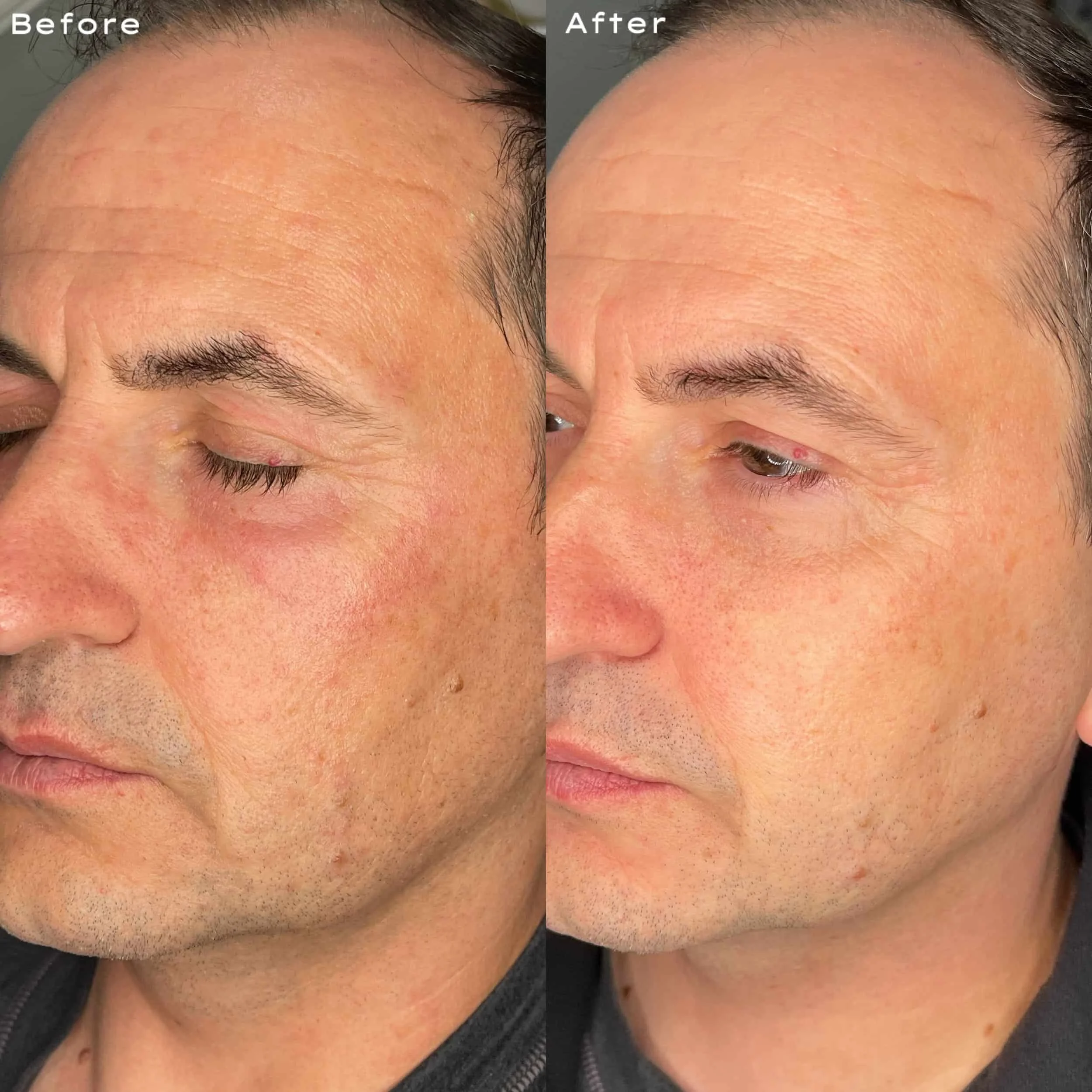 Comparison of a man's face before and after skin treatment, showing reduced redness, wrinkles, and uneven skin texture.