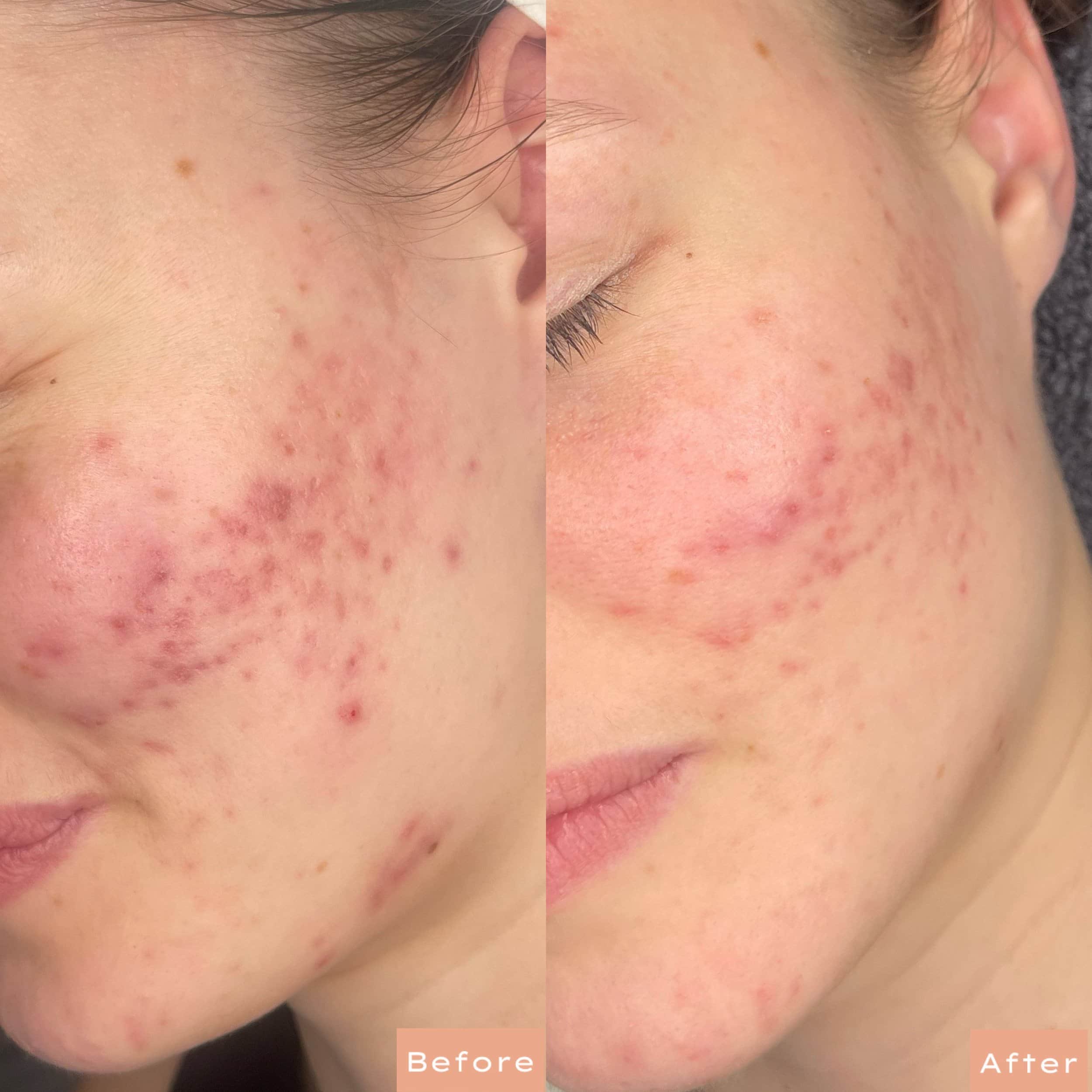Comparison of a person's cheek showing acne and skin improvement, with a 'before' image on the left and an 'after' image on the right.