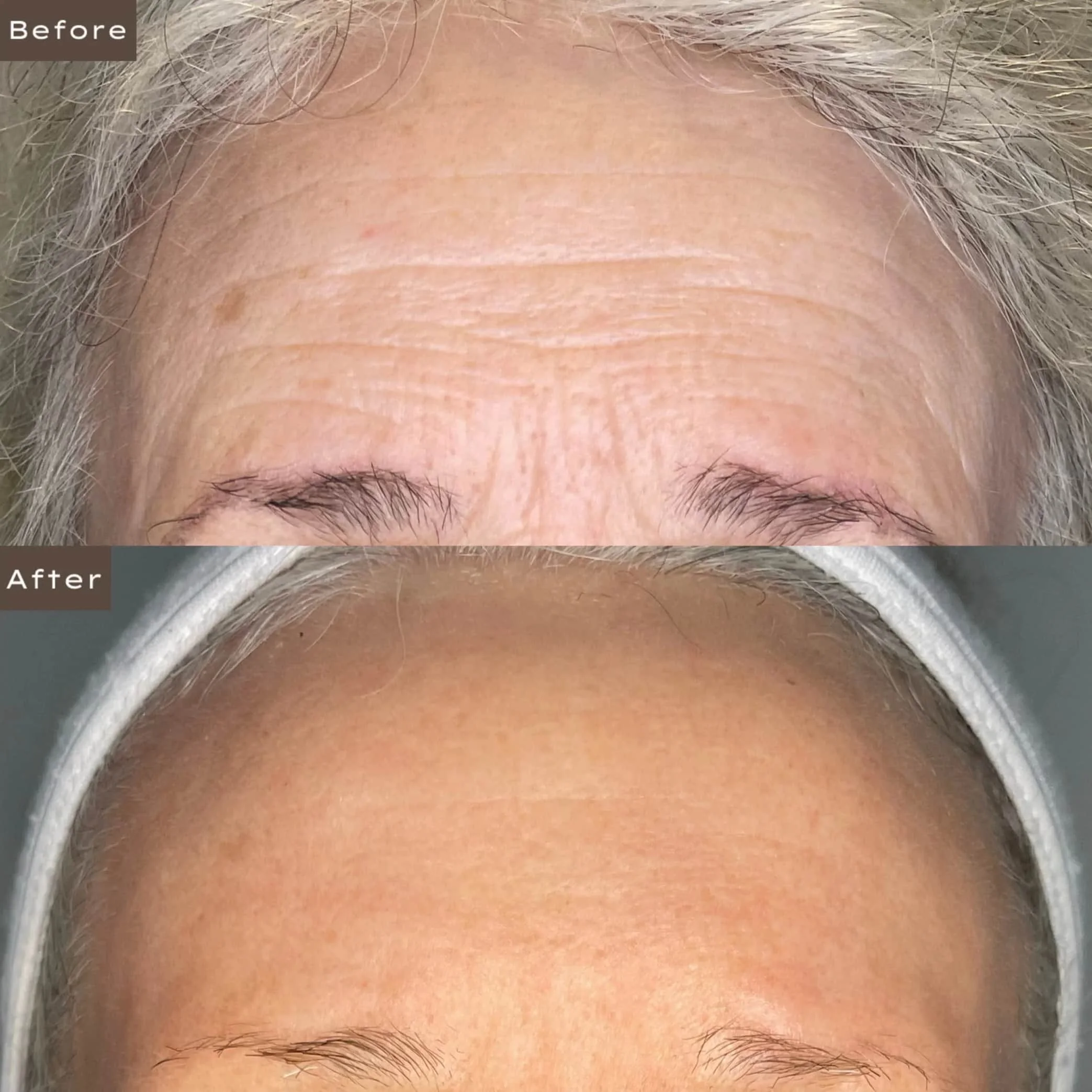 Before and after comparison of a person's forehead, showing reduced wrinkles and smoother skin after treatment.