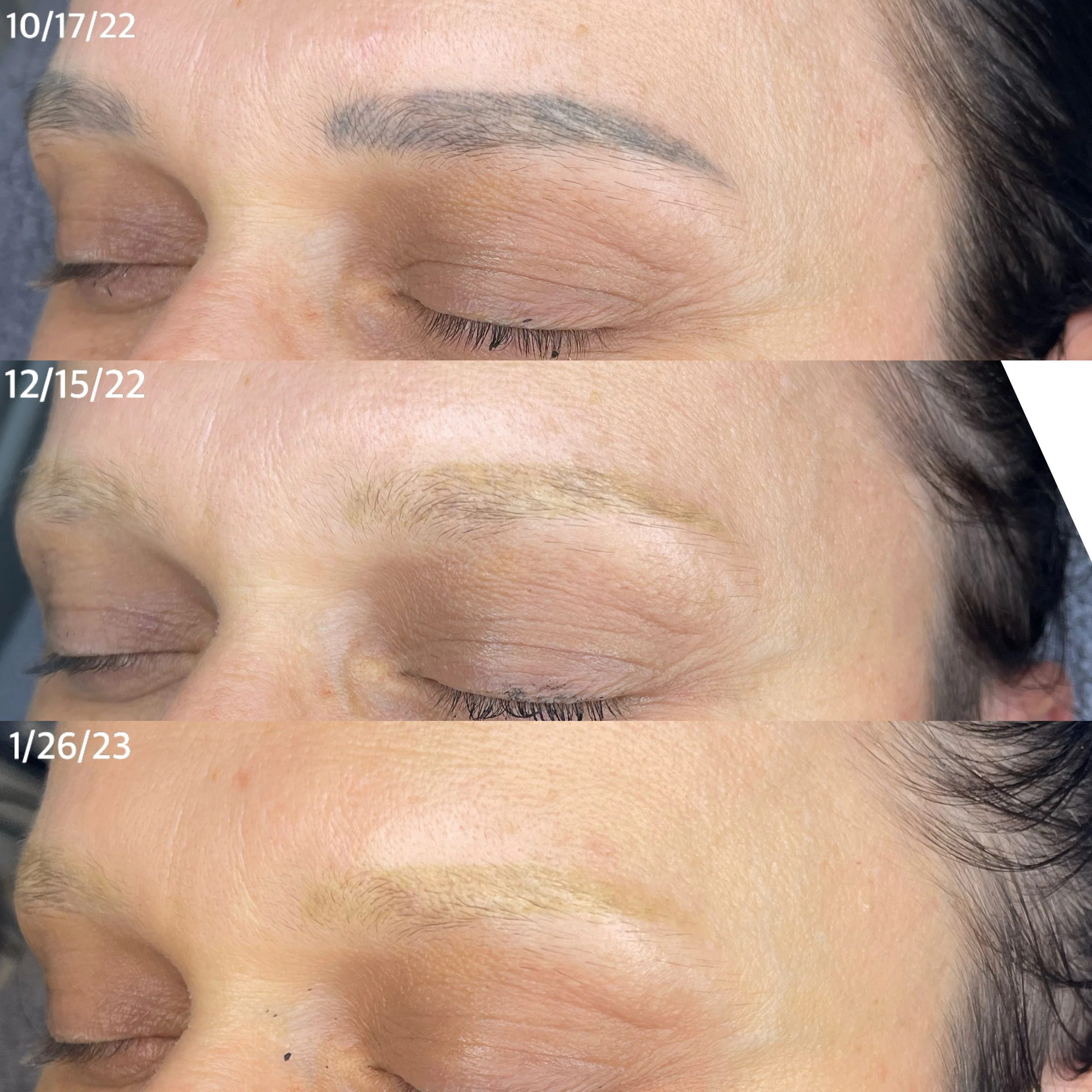 Close-up of a person's closed eye in three different stages: before treatment with visible eyebrow, after initial treatment with sparse eyebrows, and after completion with fuller, more defined eyebrows.