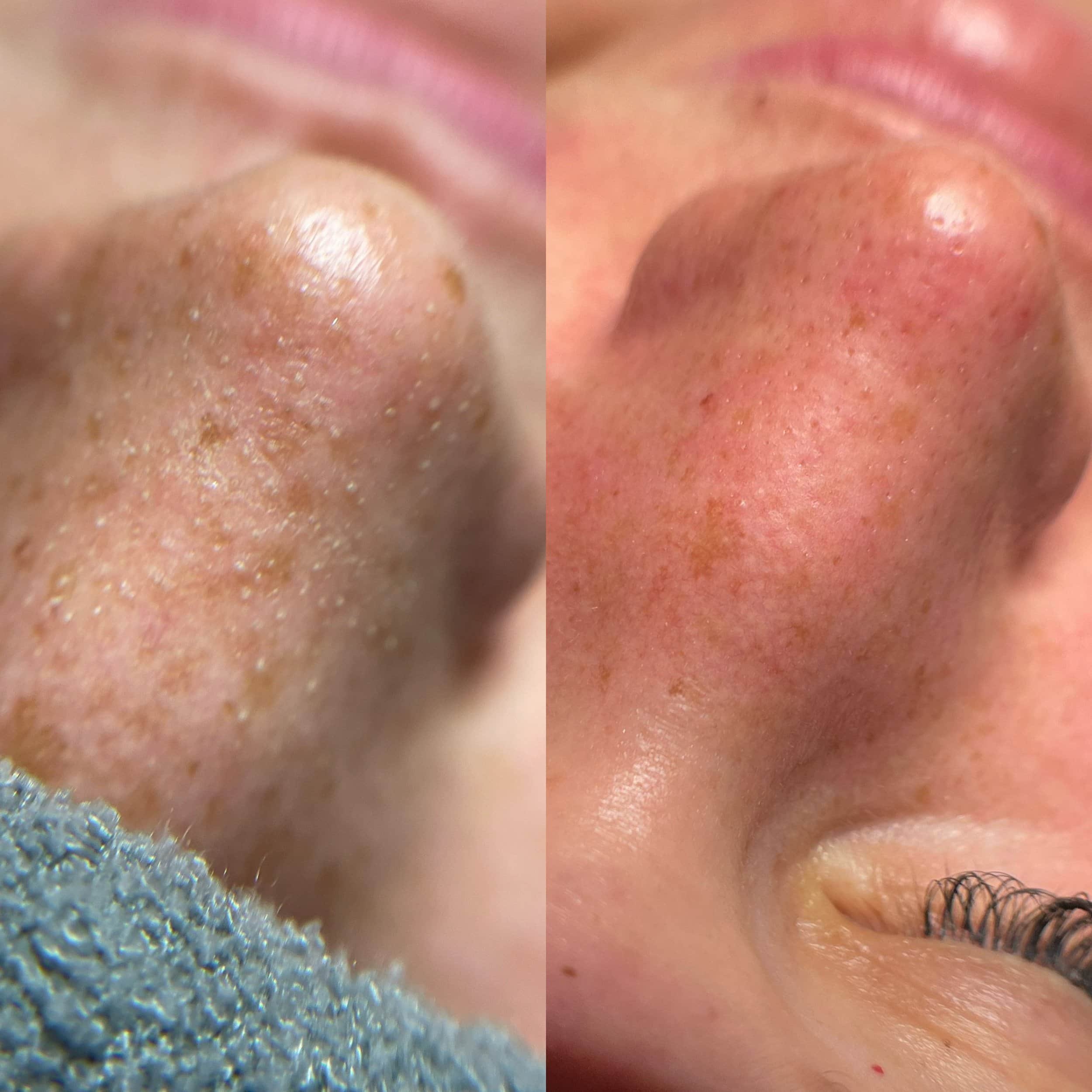 Close-up images of a person's nose showing enlarged pores and blackheads, with the right image showing clearer skin.