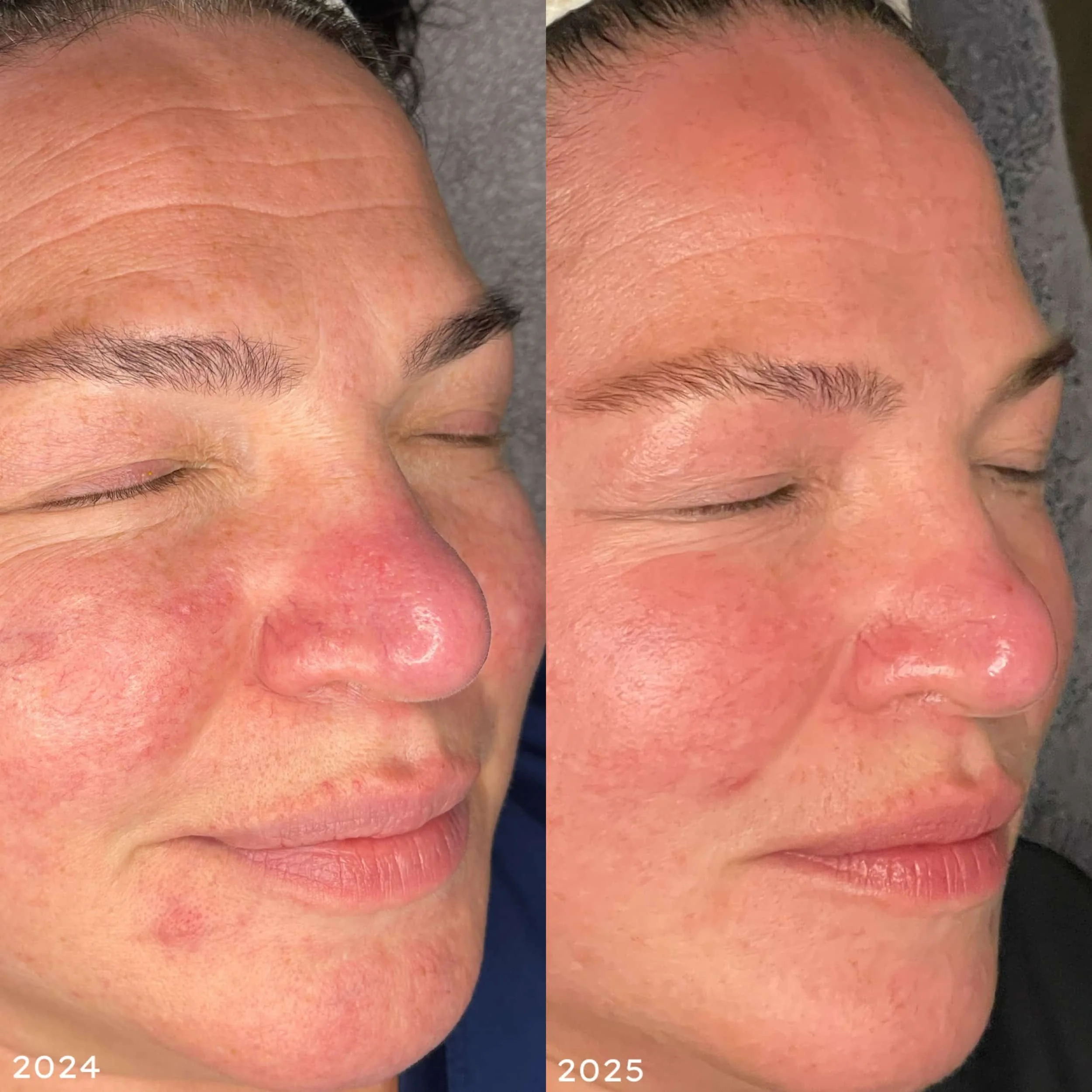 Side-by-side comparison of a woman's face before and after a skincare treatment, showing improved skin texture and redness reduction from 2024 to 2025.