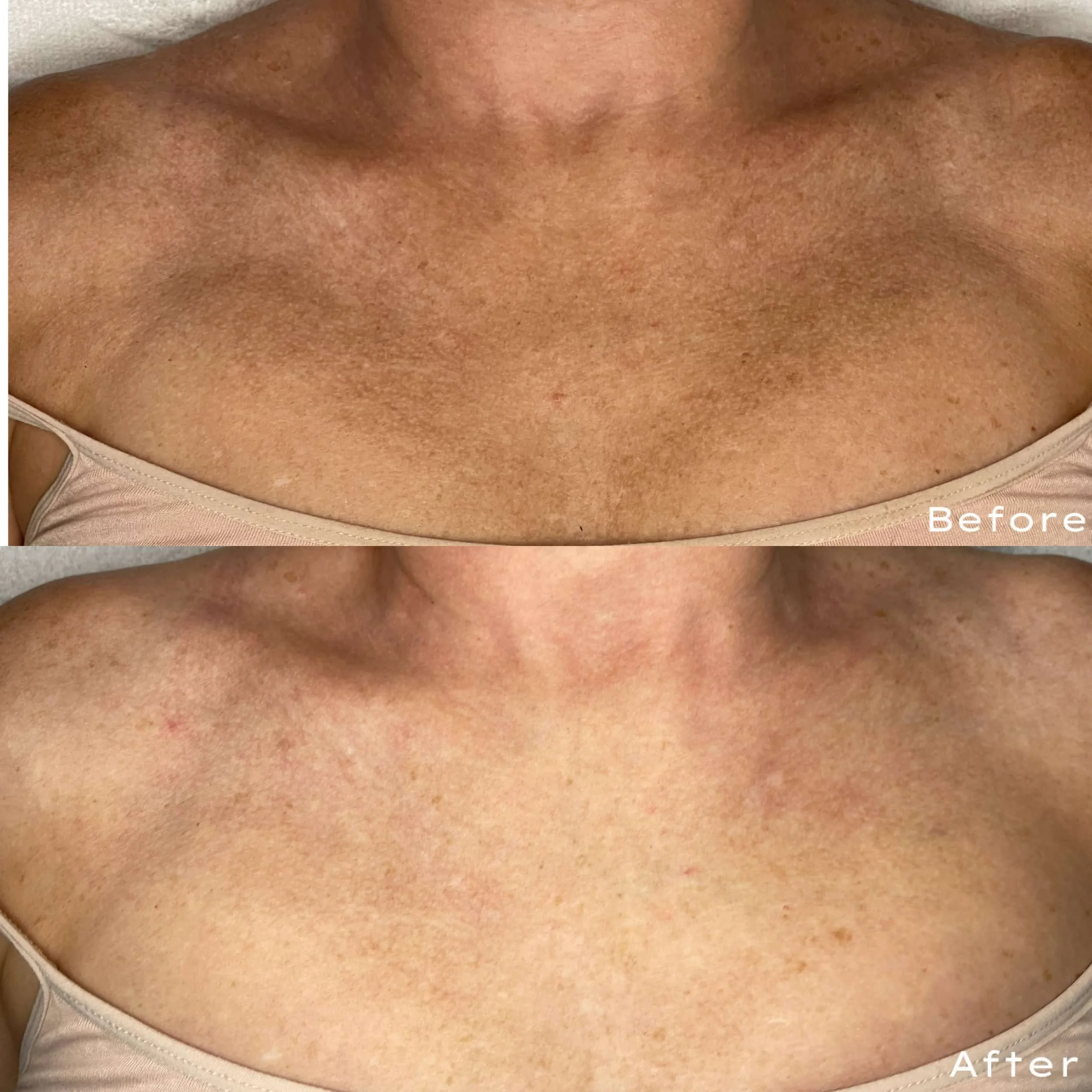 Comparison of a person's chest skin before and after a skincare treatment, showing smoother and clearer skin in the after image.