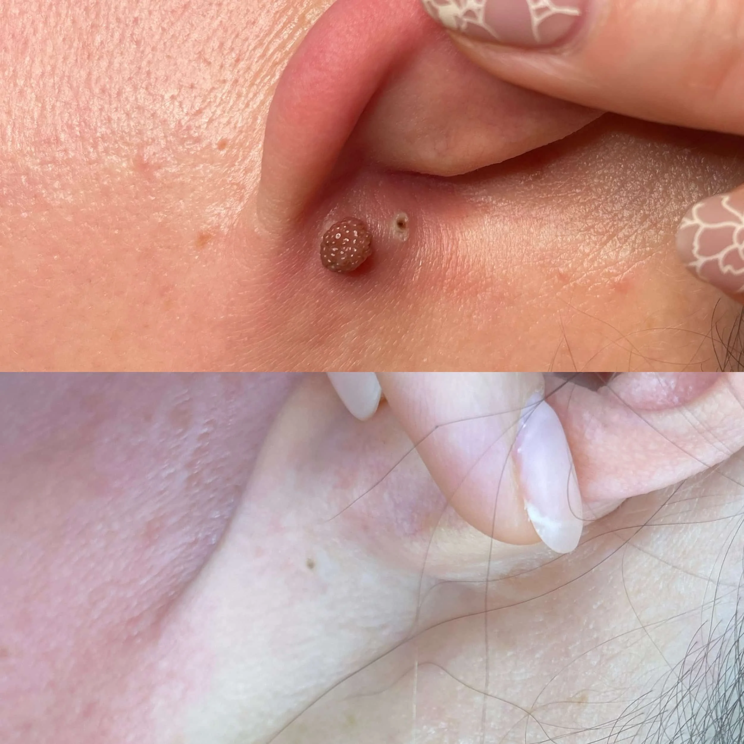 Close-up of two people's earlobes with skin tags, one on each earlobe.