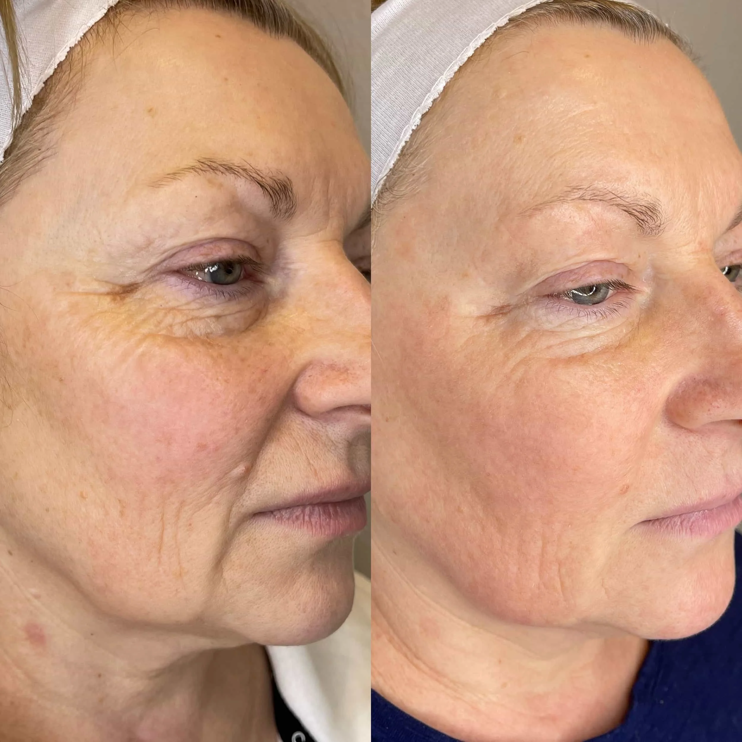 Comparison of a woman's face showing improvement in skin texture, wrinkles, and pigmentation after a skincare treatment or procedure.