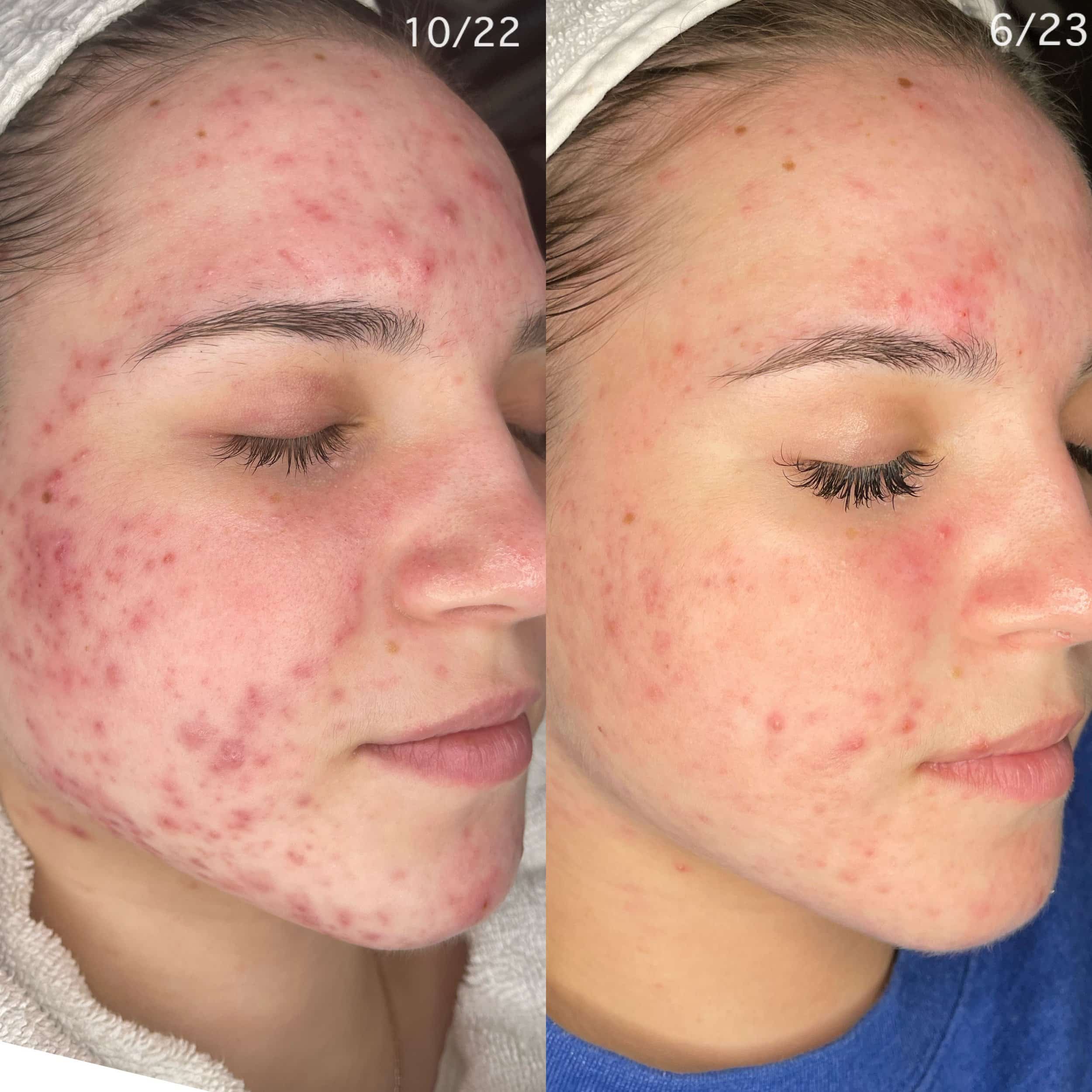 Comparison of a woman's face showing a significant reduction in acne and skin redness from October 22 to June 23.