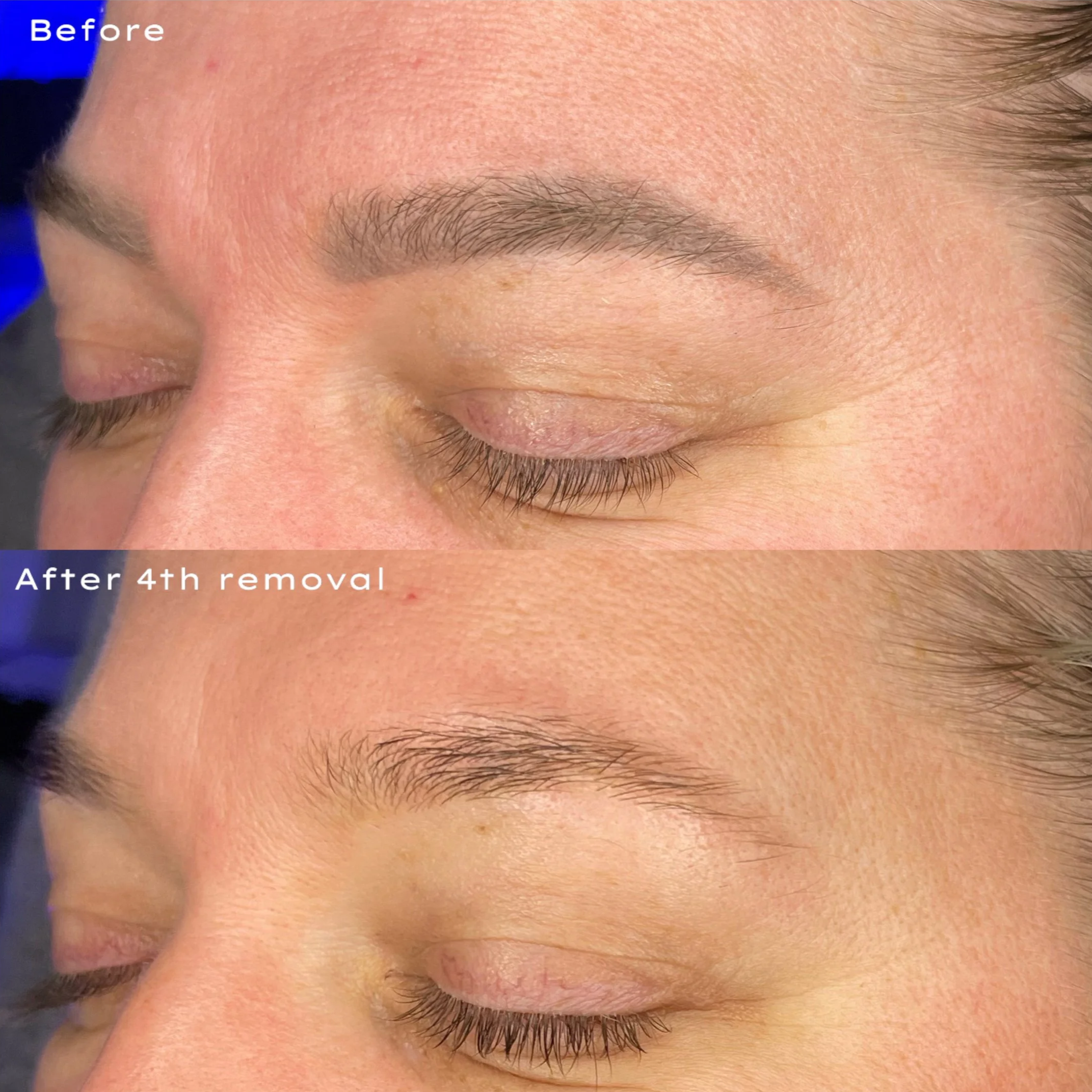 Close-up of a person's eyebrow before and after 4th removal, showing clearer skin and reduced eyebrow hair in the after image.