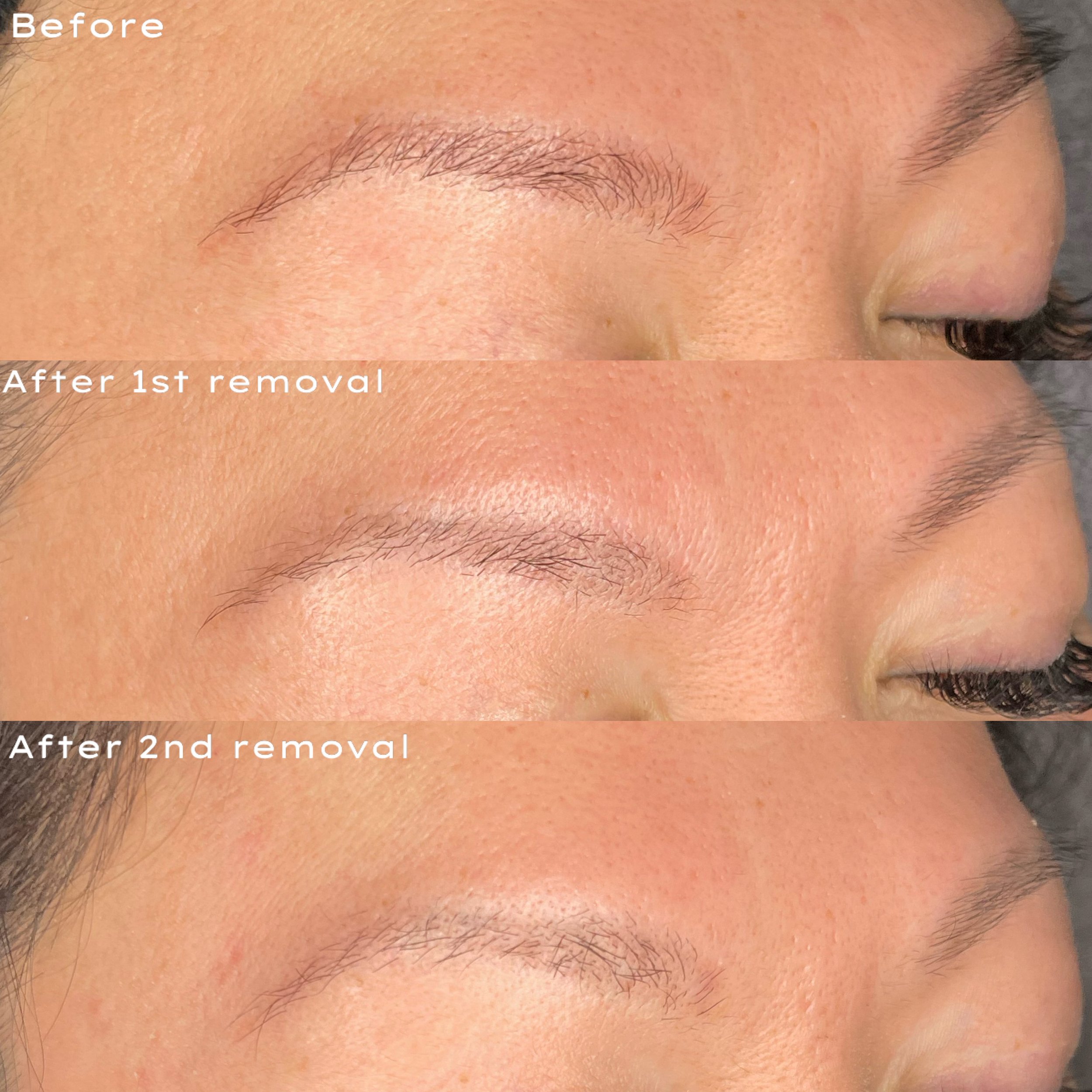 Close-up of a person's eyebrow showing the appearance before and after two hair removal treatments, highlighting the reduction in eyebrow hair density.