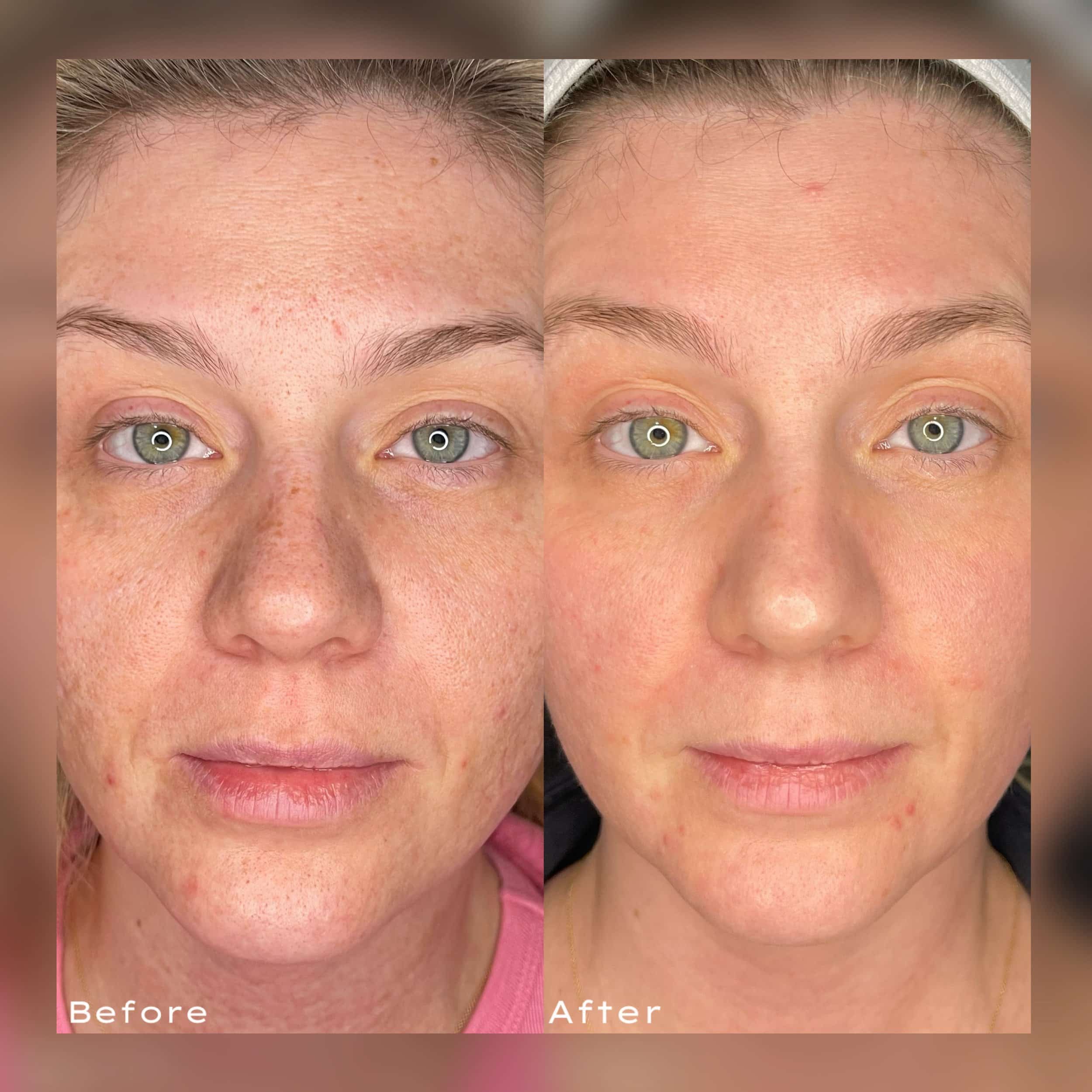 Side-by-side comparison of a woman's face before and after skincare treatment. The left shows skin with redness, visible pores, and blemishes. The right shows smoother, clearer skin with reduced redness and fewer blemishes.