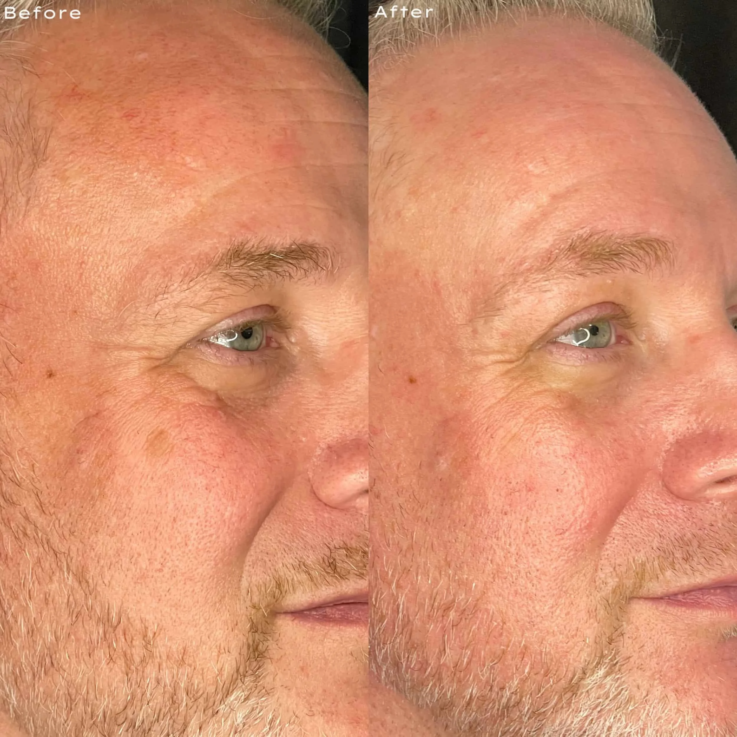Comparison of a man's face before and after skincare treatment, showing smoother skin with fewer wrinkles and redness in the after image.