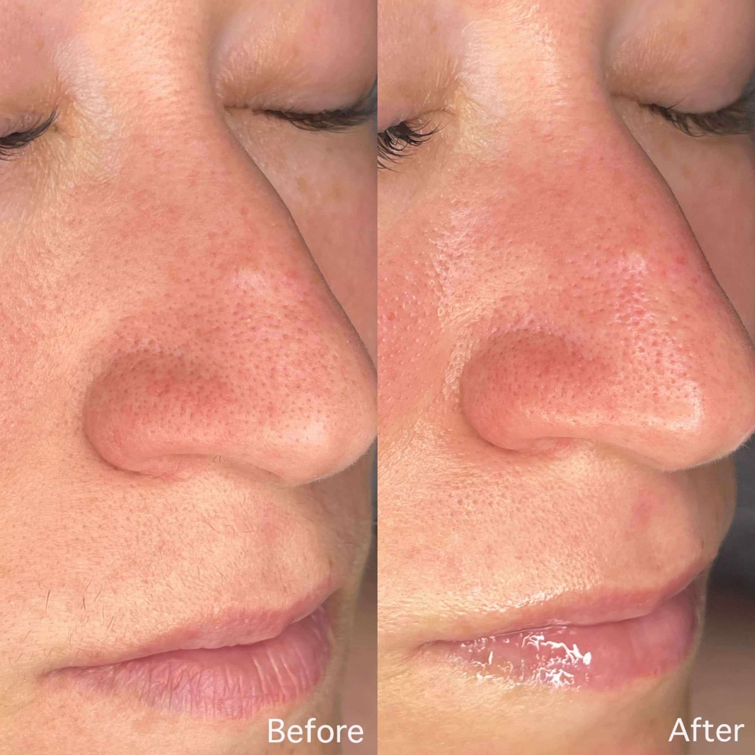 Close-up side-by-side comparison of a person's nose, showing the skin before and after a skin treatment. The 'before' side displays visible redness, enlarged pores, and rough skin texture. The 'after' side shows smoother skin with less redness and smaller pores, with some shine on the skin.