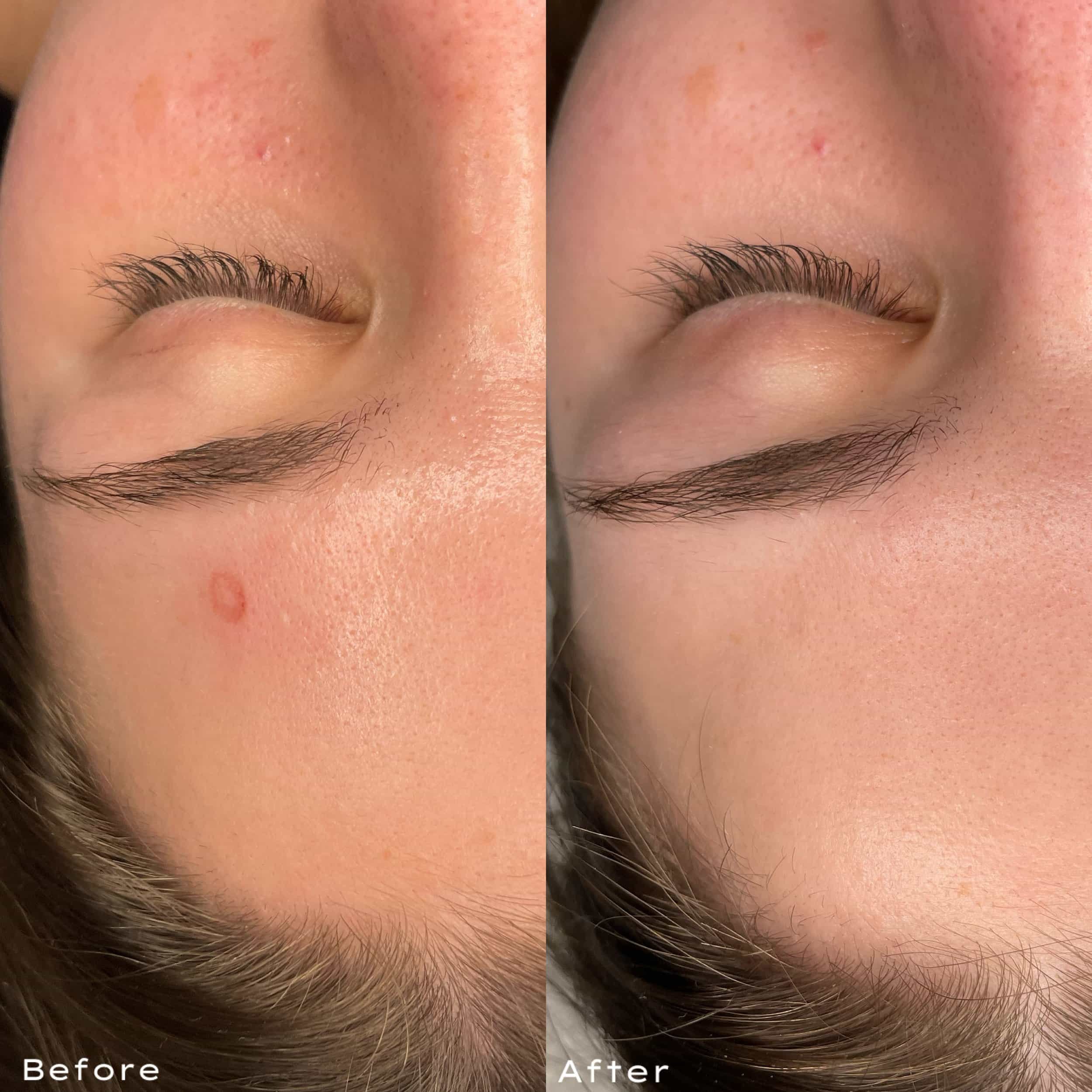 Close-up of a person's face showing a side-by-side comparison of skin before and after treatment. The 'before' side shows a blemish on the cheek, while the 'after' side shows clear skin with no blemish.