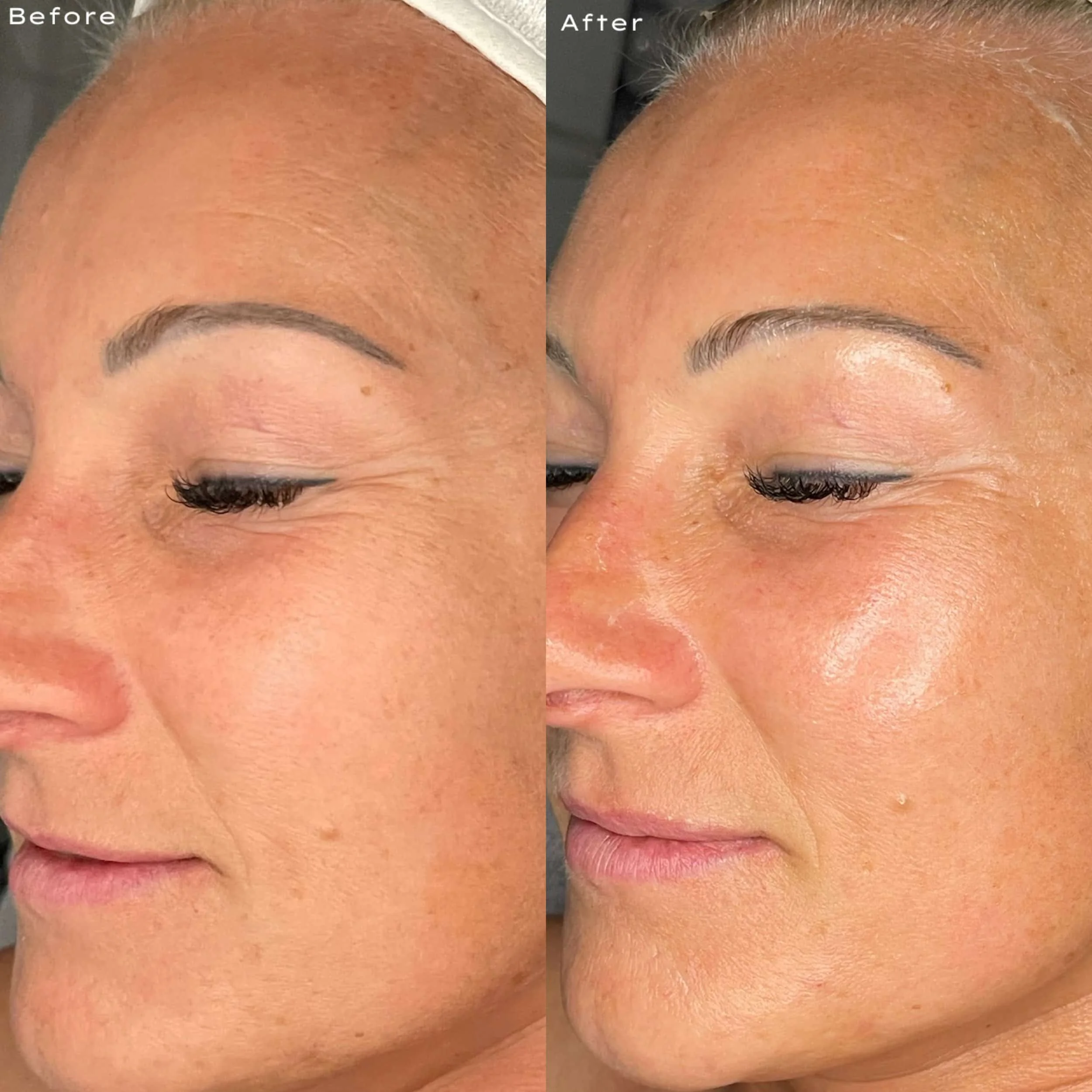 Close-up side-by-side comparison of a woman's face before and after a skincare or cosmetic treatment, showing smoother, clearer skin in the after image, with visible improvements in skin texture and tone.