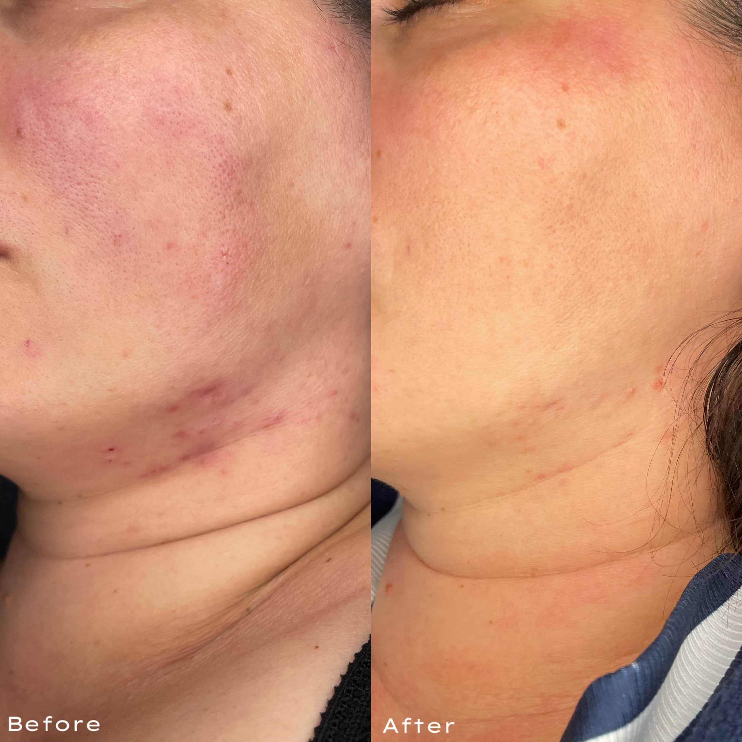 A split view showing skin on a person's face and neck before and after skincare treatment, with the left side labeled 'Before' showing redness and blemishes, and the right side labeled 'After' showing clearer, smoother skin.