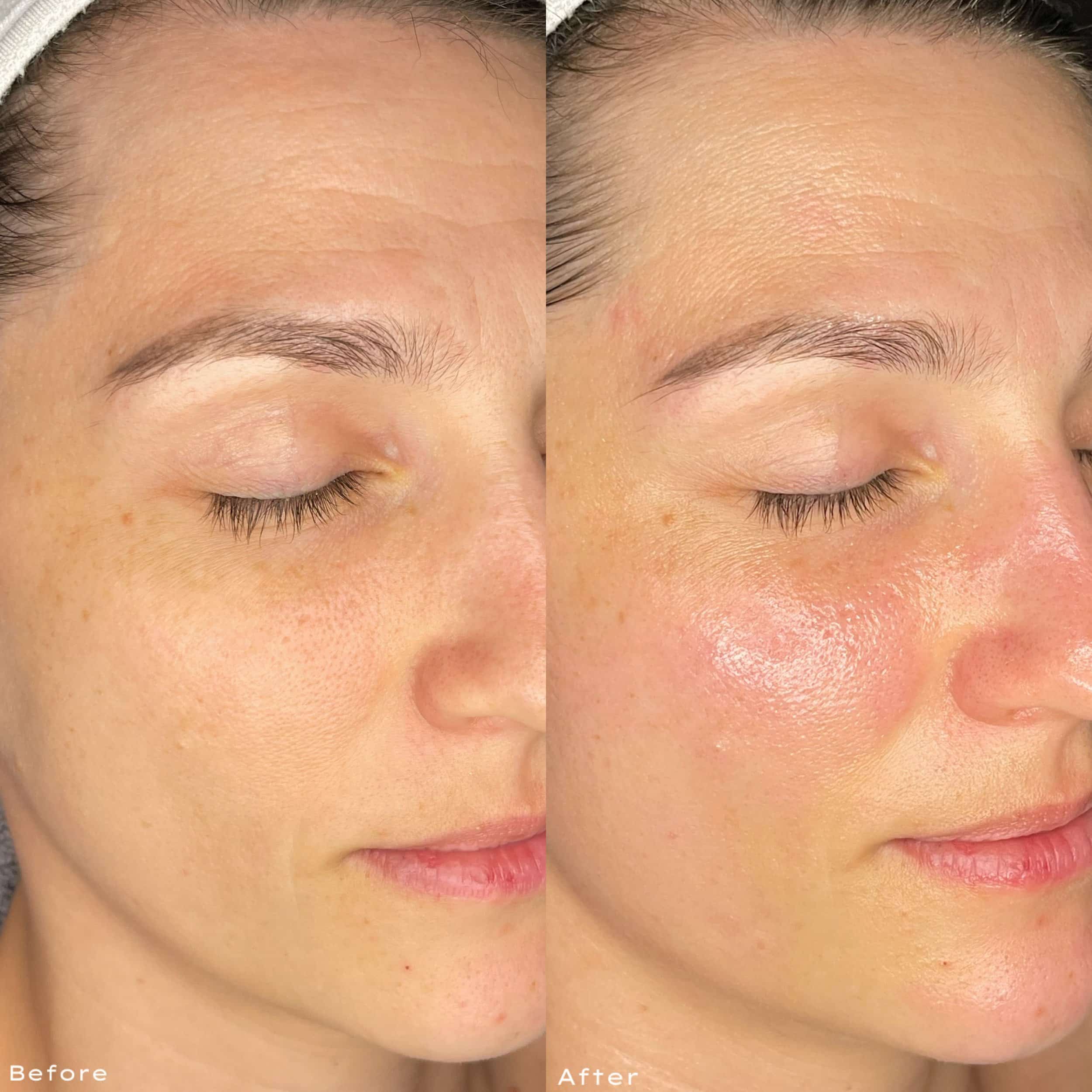 Side-by-side comparison of a woman’s face showing skin before and after a skincare treatment, with visible improvement in skin texture and glow.
