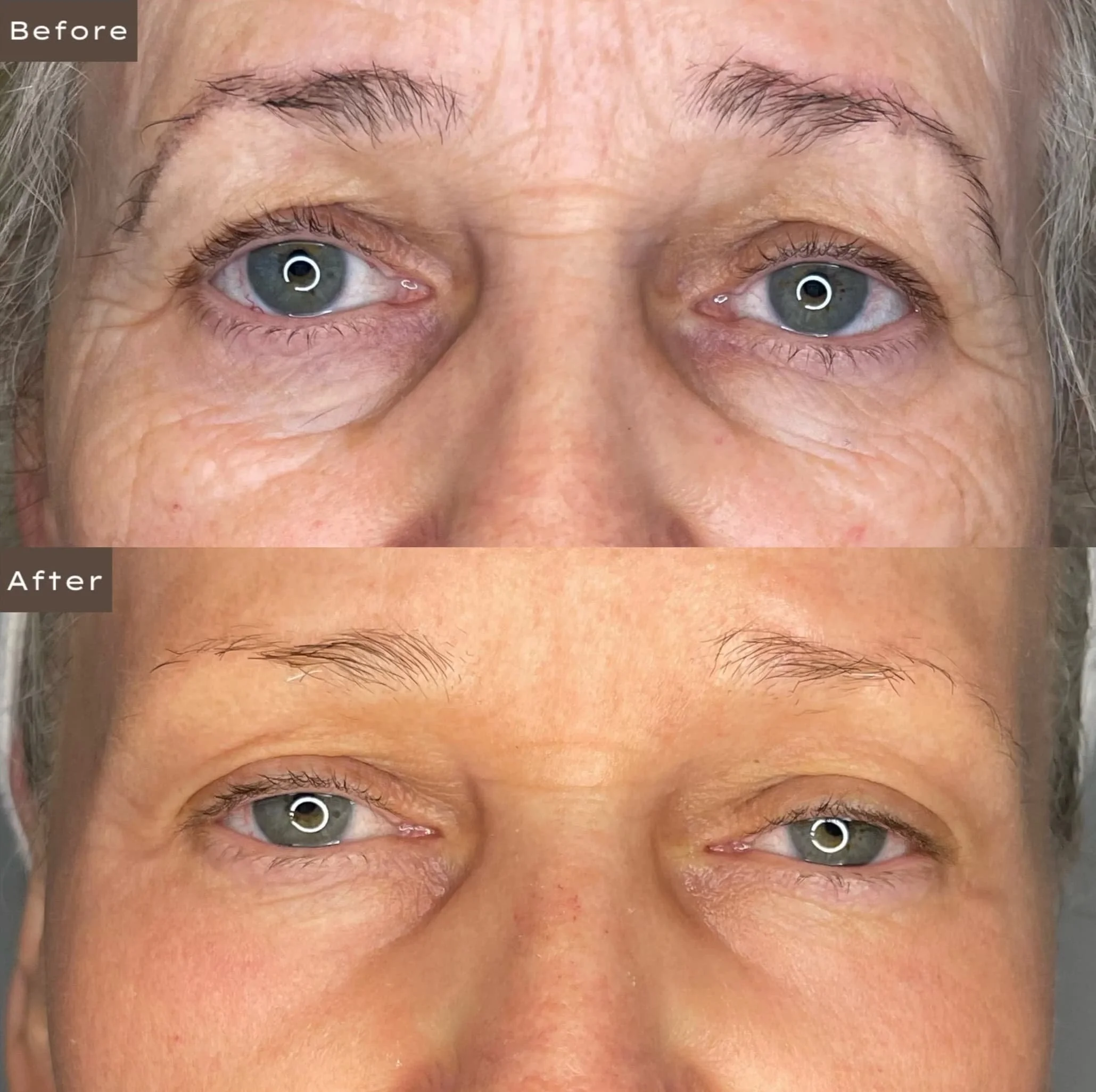Close-up comparison of a woman's eyes showing before and after cosmetic treatment, focusing on reduced under-eye puffiness and wrinkles.