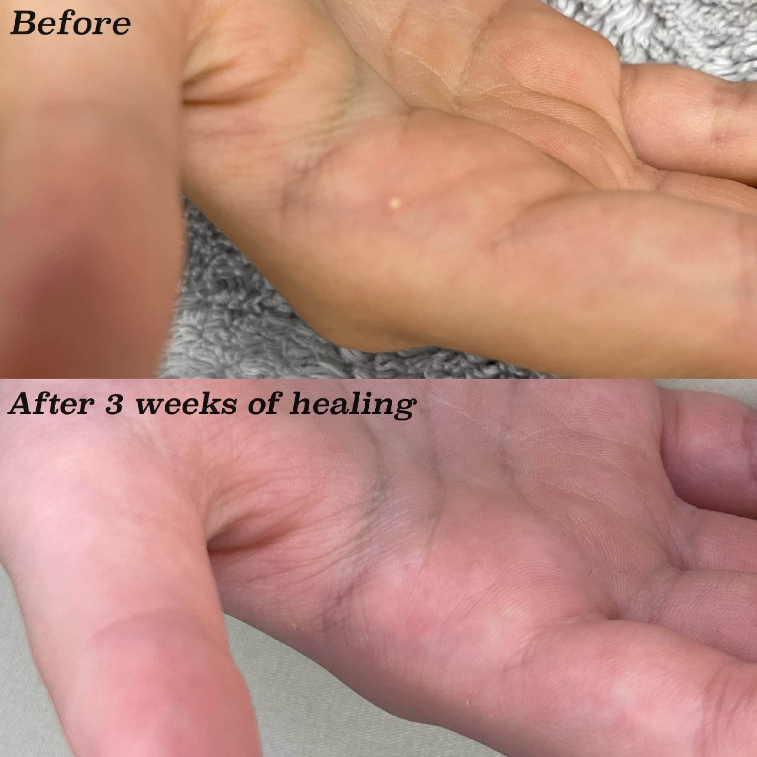 Comparison photo showing a finger before and after 3 weeks of healing, with the after image displaying a healed, less irritated skin area.
