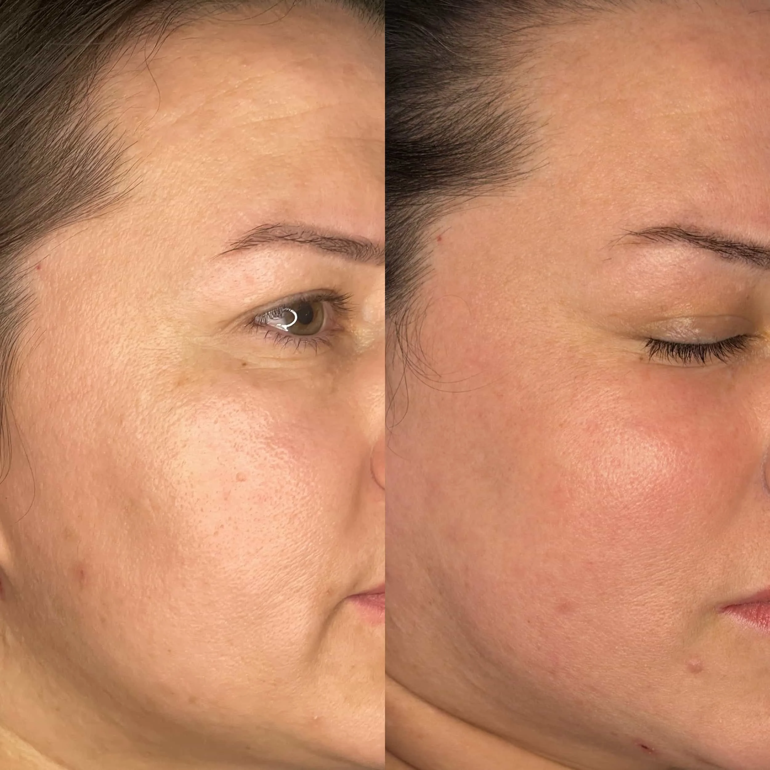 Side-by-side comparison of a woman's face before and after skincare, showing clearer, smoother skin on the right.