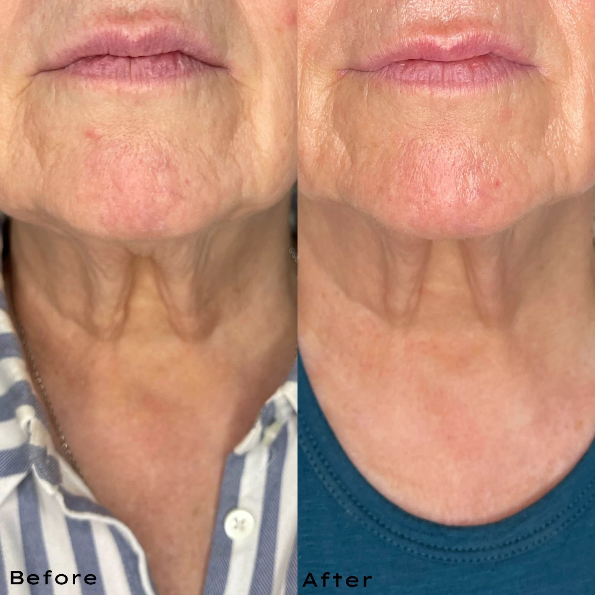 Side-by-side comparison of a woman's lower face and neck showing improvement in skin texture and redness after treatment, with text labeling 'Before' and 'After'.