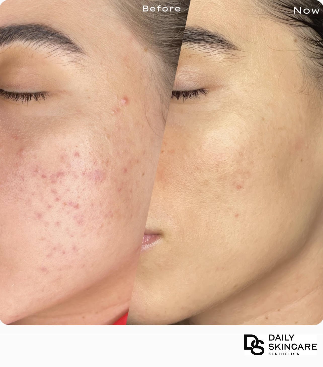Side-by-side comparison of a woman's face showing skin with acne and scars before, and clear skin after skincare treatment, with 'Before' and 'Now' labels at the top.