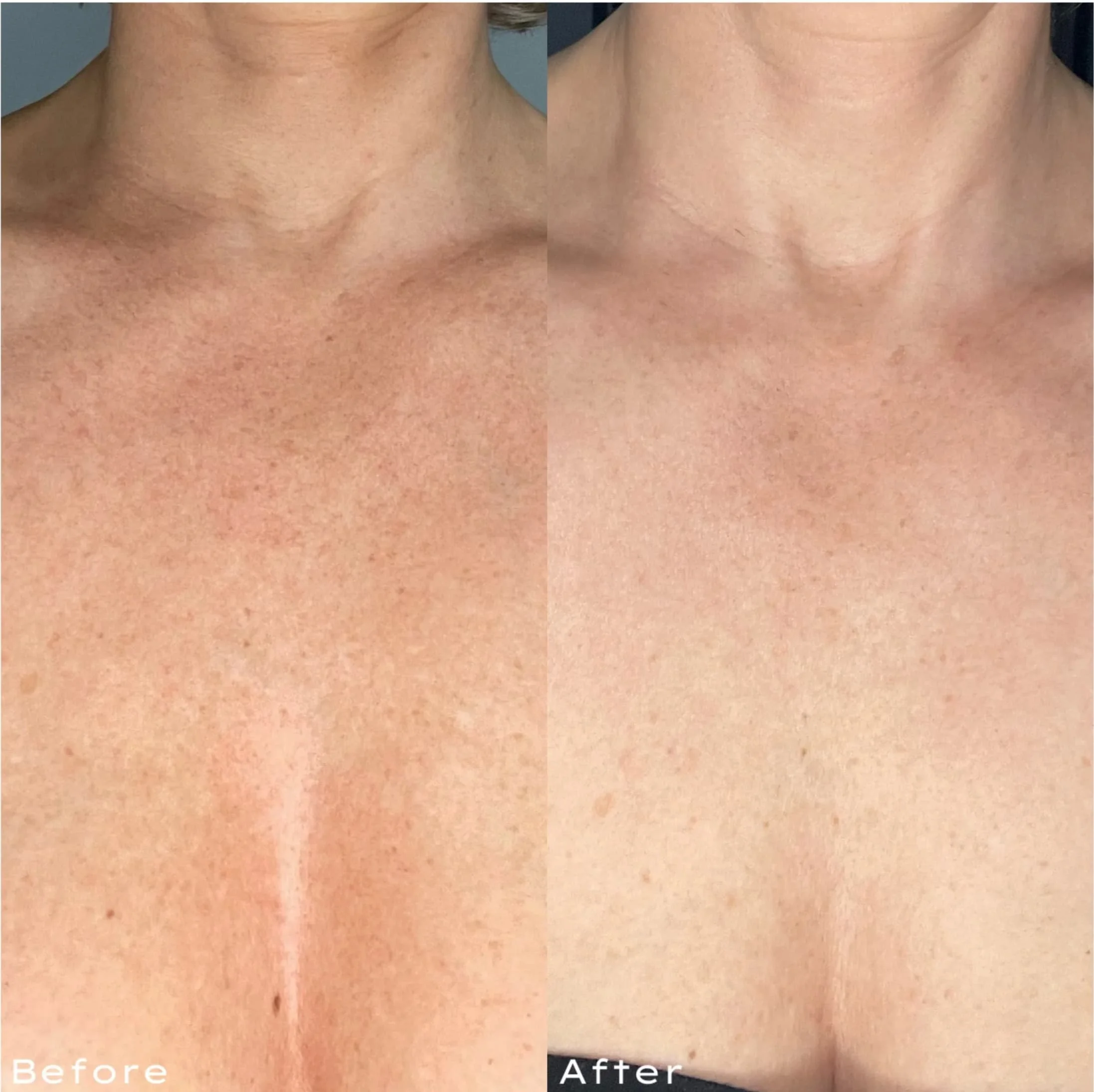 Comparison of skin texture on a person's chest area before and after skincare, showing improved smoothness and reduced redness in the after image.